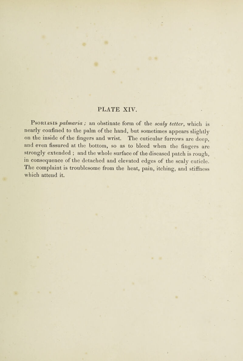 Psoriasis pahnaria ; an obstinate form of the scaly tetter, which is nearly confined to the palm of the hand, but sometimes appears slightly on the inside of the fingers and wrist. The cuticular furrows are deep, and even fissured at the bottom, so as to bleed when the fino’ers are strongly extended ; and the whole surface of the diseased patch is rough, in consequence of the detached and elevated edges of the scaly cuticle. The complaint is troublesome from the heat, pain, itching, and stiffness which attend it.