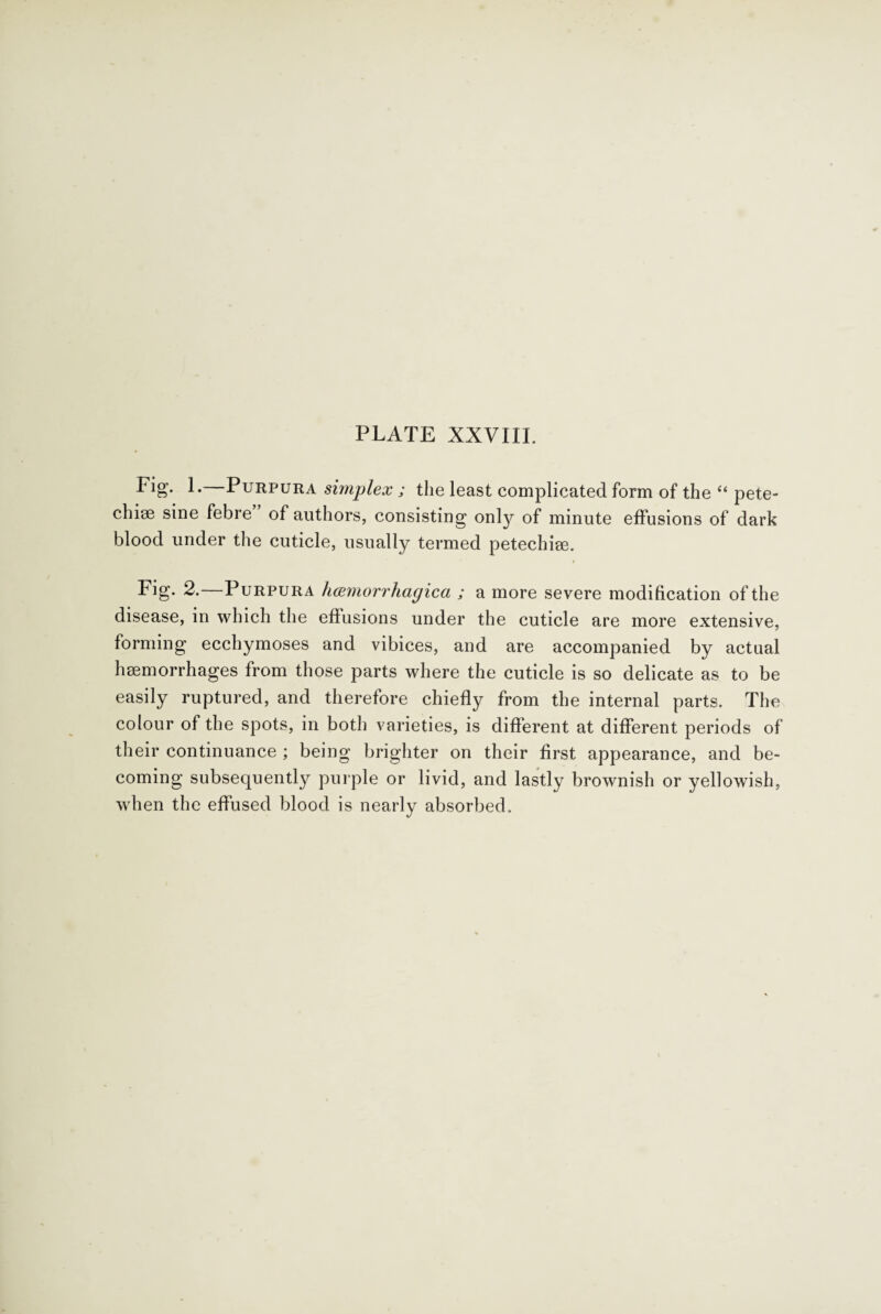 Fig- L—Purpura simplex ; the least complicated form of the “ pete¬ chia sine febre of authors, consisting only of minute effusions of dark blood under the cuticle, usually termed petechiae. Fig. 2.—Purpura hemorrhagica ; a more severe modification of the disease, in which the effusions under the cuticle are more extensive, forming ecchymoses and vibices, and are accompanied by actual haemorrhages from those parts where the cuticle is so delicate as to be easily ruptured, and therefore chiefly from the internal parts. The colour of the spots, in both varieties, is different at different periods of their continuance ; being brighter on their first appearance, and be¬ coming subsequently purple or livid, and lastly brownish or yellowish, when the effused blood is nearly absorbed.