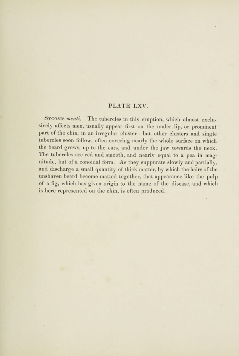 Sycosis menti. The tubercles in this eruption, which almost exclu¬ sively affects men, usually appear first on the under lip, or prominent part of the chin, in an irregular cluster : but other clusters and single tubercles soon follow, often covering nearly the whole surface on which the beard grows, up to the ears, and under the jaw towards the neck. The tubercles are red and smooth, and nearly equal to a pea in mag¬ nitude, but of a conoidal form. As they suppurate slowly and partially, and discharge a small quantity of thick matter, by which the hairs of the unshaven beard become matted together, that appearance like the pulp of a fig, which has given origin to the name of the disease, and which is here represented on the chin, is often produced.