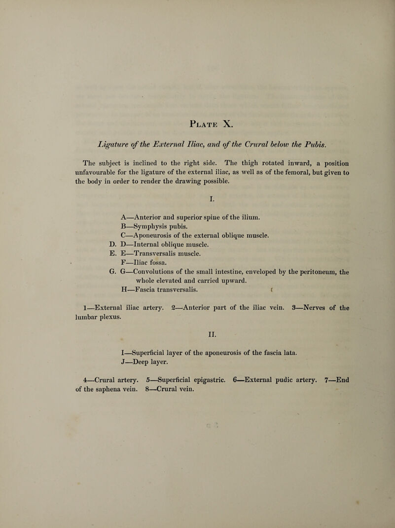 Plate X. Ligature of the External Iliac, and of the Crural below the Pubis. The subject is inclined to the right side. The thigh rotated inward, a position unfavourable for the ligature of the external iliac, as well as of the femoral, but given to the body in order to render the drawing possible. I. A—Anterior and superior spine of the ilium. B—Symphysis pubis. C—Aponeurosis of the external oblique muscle. D. D—Internal oblique muscle. E. E—Transversalis muscle. F—Iliac fossa. G. G—Convolutions of the small intestine, enveloped by the peritoneum, the whole elevated and carried upward. H—Fascia transversalis. < 1—External iliac artery. 2—Anterior part of the iliac vein. 3—Nerves of the lumbar plexus. II. I—Superficial layer of the aponeurosis of the fascia lata. J—Deep layer. 4—Crural artery. 5—Superficial epigastric. 6—External pudic artery. 7—End of the saphena vein. 8—Crural vein.