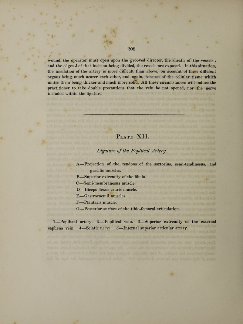 wound, the operator must open upon the grooved director, the sheath of the vessels ; and the edges J of that incision being divided, the vessels are exposed. In this situation, the insulation of the artery is more difficult than above, on account of these different organs being much nearer each other, and again, because of the cellular tissue which unites them being thicker and much more solid. All these circumstances will induce the practitioner to take double precautions that the vein be not opened, nor the nerve included within the ligature. Plate XII. Ligature of the Popliteal Artery. A—Projection of the tendons of the sartorius, semi-tendinosus, and gracilis muscles. B—Superior extremity of the fibula. C—Semi-membranosus muscle. D—Biceps flexor cruris muscle. E—Gastrocnemii muscles. F—Plantaris muscle. G—Posterior surface of the tibio-femoral articulation. 1—Popliteal artery. 2—Popliteal vein. 3—Superior extremity of the external saphena vein. 4—Sciatic nerve. 5—Internal superior articular artery.