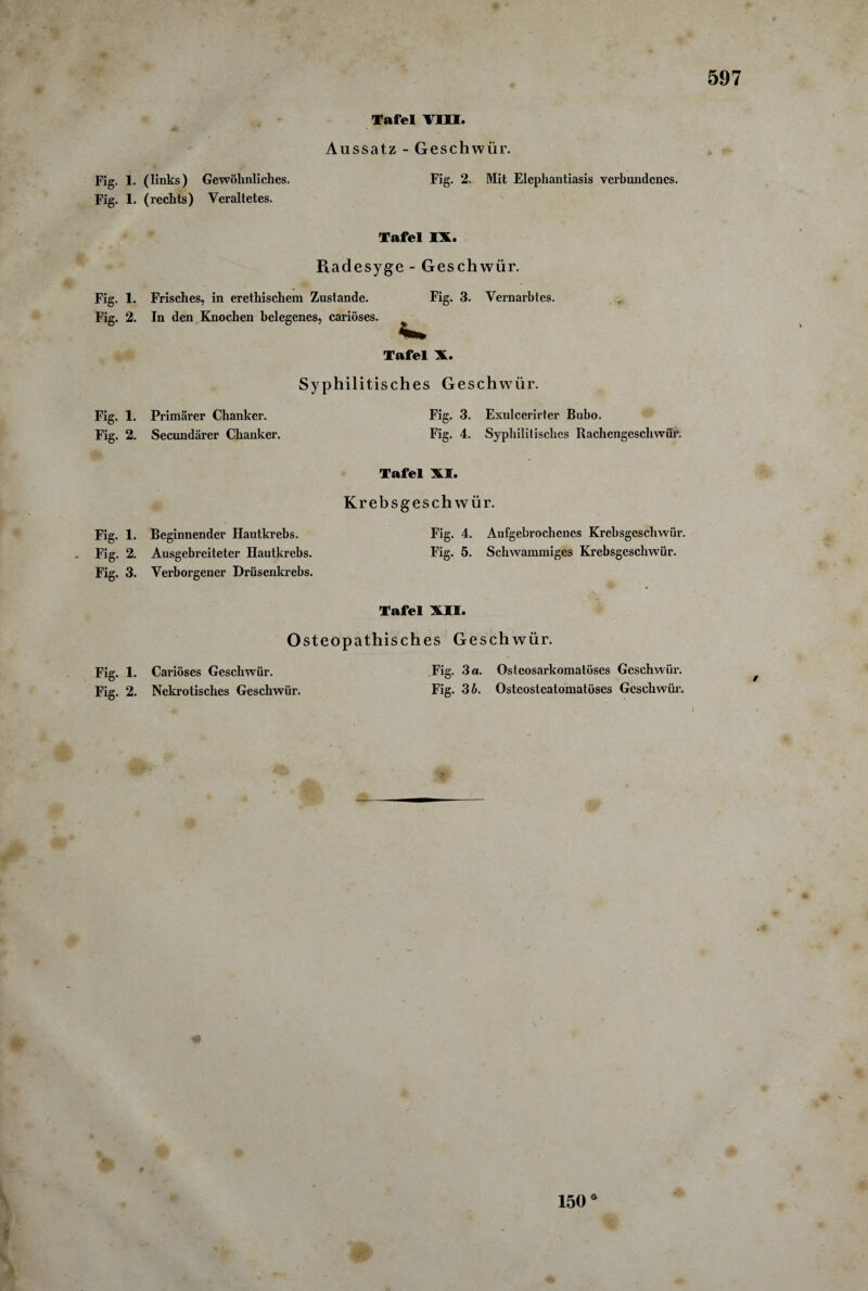 Tafel VIII. Aussatz - Geschwür. 597 Fig. 1. (links) Gewöhnliches. Fig. 2. Mit Elephantiasis verbundenes. Fig. 1. (rechts) Veraltetes. Tafel IX. Radesyge - Geschwür. Fig. 1. Frisches, in erethischem Zustande. Fig. 2. In den Knochen belegenes, cariöses. Fig. 3. Vernarbtes. Tafel X. Syphilitisches Geschwür. Fig. 1. Primärer Chanker. Fig. 3. Exulcerirter Bubo. Fig. 2. Secundärer Chanker. Fig. 4. Syphilitisches Rachengcschwiir. Tafel XI. Krebsgeschwür. Fig. 1. Beginnender Hautkrebs. Fig. 4. Aufgebrochenes Krebsgeschwür. . Fig. 2. Ausgebreiteter Hautkrebs. Fig. 5. Schwammiges Krebsgeschwür. Fig. 3. Verborgener Drüsenkrebs. Tafel XII. Osteopathisches Geschwür. Fig. 1. Cariöses Geschwür. Fig. 3 a. Ostcosarkomatüses Geschwür. Fig. 2. Nekrotisches Geschwür. Fig. 3 b. Osteostcatomatüses Geschwür. / % 0 0 150*