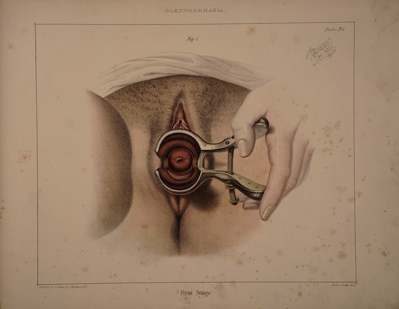 FIG. 1. —FIRST STAGE. The annexed plate was taken from a remarkably well-formed female, in the Hopital de L’Ourcine, Paris. The drawing represents the speculum introduced, the patient lying on the bed, and sup¬ porting the handles of the instrument. She had led a very dissolute life for a long period, although only twenty-one years of age. The nipple shape of the os uteri, and its transverse opening, are well seen, and prove that this female has never been impregnated. The increased redness of the vagina and os tincae bespeak inflammation which had existed only a few days. She stated that this was her first venereal complaint, and that she had never been prevented from following her avocations. The menstrual function was per¬ formed regularly ; and she would have been una¬ ware of any disease existing, had it not been from a slight pain in making water, and several persons having contracted the disease during the preceding days.