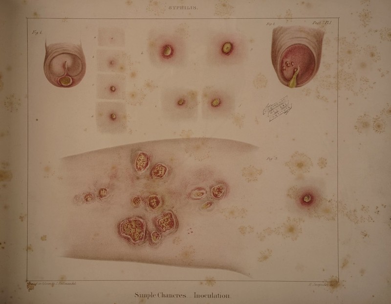 I FIG. 1.—INOCULATION-SIMPLE UNCOM¬ PLICATED CHANCRE. The original drawing was taken at the Venereal Hospital, Paris, from a patient forty years of age. Connexion had taken place six weeks previously. The patient had continued his usual occupation of a blacksmith until two days prior to entering the hospital. The characters of simple chancre are well seen, more or less circular in shape, with loss of substance; the edges of the sore neither elevated nor indurated, only slightly cedematous, with a red areola. The bottom as well as the sides of the sore are covered with tenacious yellow lymph. The letters a, b, c, d, e9f9 g, point to the progress of the artificial chancre produced by inoculation on the thigh with the secretion of fig. 1 ; a represents the inoculated point six hours after the operation, the other letters at intervals of twenty-four hours. Letter h is the chancre on the thigh about the tenth day. FIG. 2.—FOLLICULAR CHANCRES. Represents a case similar to that of Mr. H., detailed at page 231. The drawing was taken two days after the appearance of the affection, and ten days after connexion. We observe the co-existence of gonorrhoea ; the pus is seen issuing from the urethra. The principal object, however, is the developement of the virus in the follicles on the glans, resembling the appearance seen in fig. marked a, b. FIG. 3.—CHANCRES ON THE LEG. This drawing represents chancres existing on the leg ; their nature was proved by inoculation, and the production of the characteristic pustule a. The characters are similar to those of simple chancre seen in fig. 1. The patient stated that for some time he had been in the daily habit of dressing a sore on the penis, and suffered at the same time from an eruption on the leg, which he often scratched ; the eruption on his leg had sub¬ sequently festered. #