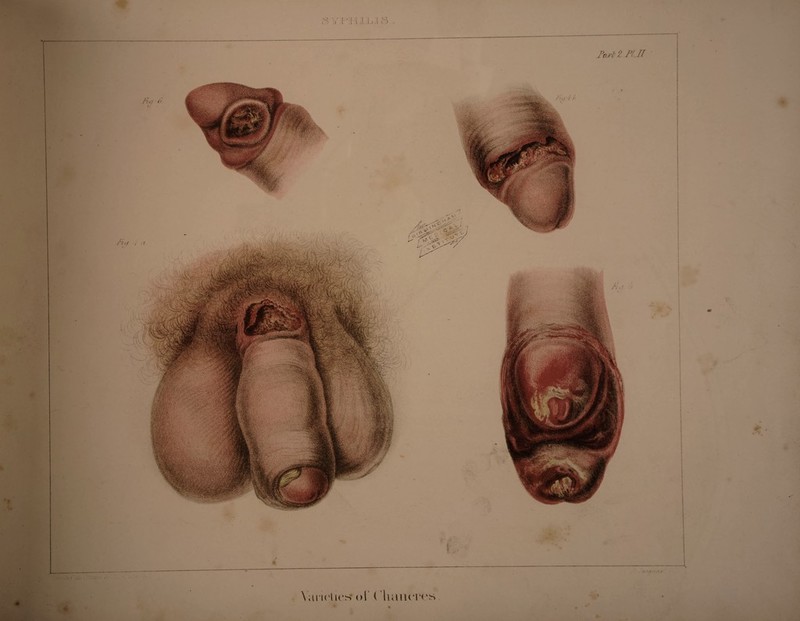 FIG. 4—a. FIG. 5 —GANGRENOUS CHANCRE. GANGLIONIC ULCERATED BUBO. This drawing’ was taken from a patient under the care of M. Ricord. A mason by trade; twenty- nine years of age. On entering the hospital this patient s constitution appeared broken down by the combined effect of dissolute habits and poverty. A thin ichorous discharge flows from under the pre¬ puce, from which a piece of lint, soaked in opium, is seen projecting. A distinct chord was felt, ex¬ tending upwards, in the direction of the ganglionic bubo, which commenced as a pimple. It was im¬ possible to collect dates from this person. FIG. 4—b. DIPHTHERITIC PHAGEDENIC CHANCRE. . -.•■'A- This is the uncovered glans penis delineated in last Fig. ; the phagedena is seen extending rather in breadth than in depth ; no induration accompa¬ nies it; but we observe some oedema around the ulceration. I should wish to call attention to the analogy of ulcerations in the same individual. This affection occurred in a young man twenty years of age, a bargeman on the Seine ; who drank freely. He stated that eighteen days previous to his admission, he had had connexion with a prostitute at Rouen ; fourteen days after a black spot showed itself on the upper part of the prepuce, which had become swollen and red, and had increased to the extent seen in the drawing. The whole of the pre¬ puce was destroyedin the succeeding thirty-six hours. 4 - A FIG. 6. INDURATED PHAGEDENIC CHANCRE. This patient, a tailor by trade, twenty-three years of age, of a beautiful transparent complexion, stated that six weeks previously he had contracted chancres; they healed under simple treatment, and the cicatrix became indurated, and then red ; and lastly a sore began in the centre, which has since been extending; a similar sore existed on the other side of the glans. Ihe molecular gangrene is very marked, and the transparent indurated circle around it, elevated and distinct from the surrounding skin, is well seen.