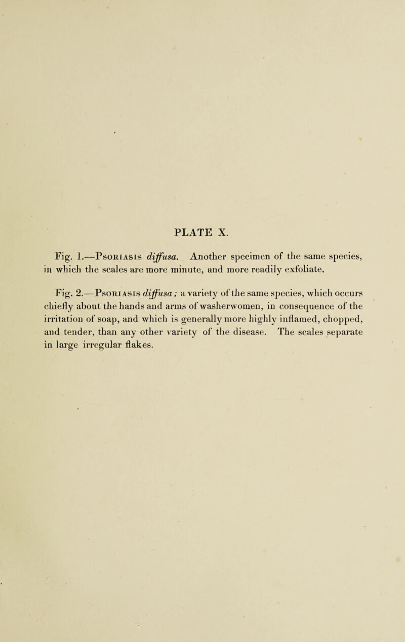 Fig. 1.—Psoriasis diffusa. Another specimen of the same species, in which the scales are more minute, and more readily exfoliate. Fig. 2.—Psoriasis diffusa; a variety of the same species, which occurs chiefly about the hands and arms of washerwomen, in consequence of the irritation of soap, and which is generally more highly inflamed, chopped, and tender, than any other variety of the disease. The scales separate in large irregular flakes.