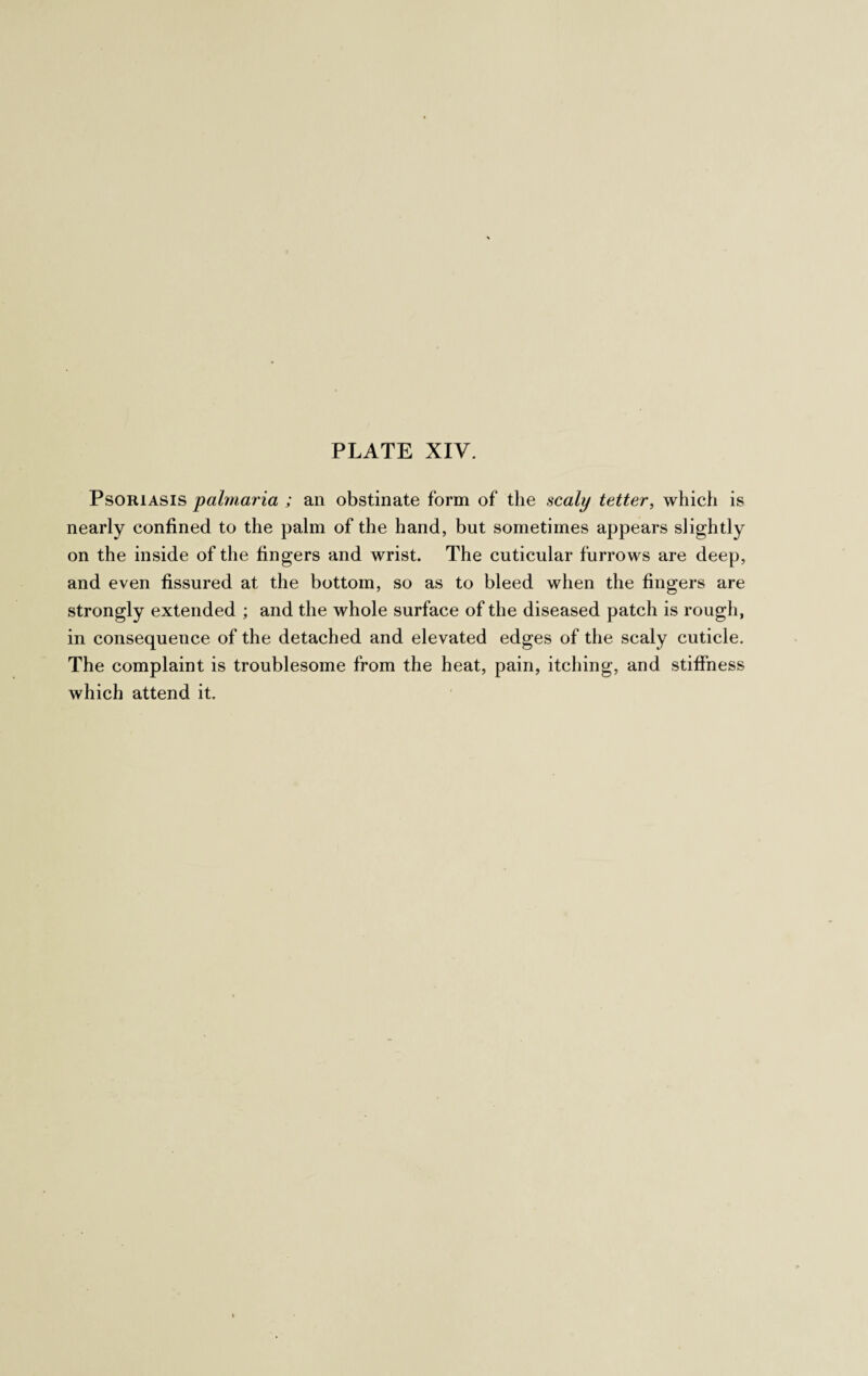 Psoriasis palmaria ; an obstinate form of the scaly tetter, which is nearly confined to the palm of the hand, but sometimes appears slightly on the inside of the fingers and wrist. The cuticular furrows are deep, and even fissured at the bottom, so as to bleed when the fingers are strongly extended ; and the whole surface of the diseased patch is rough, in consequence of the detached and elevated edges of the scaly cuticle. The complaint is troublesome from the heat, pain, itching, and stiffness which attend it.
