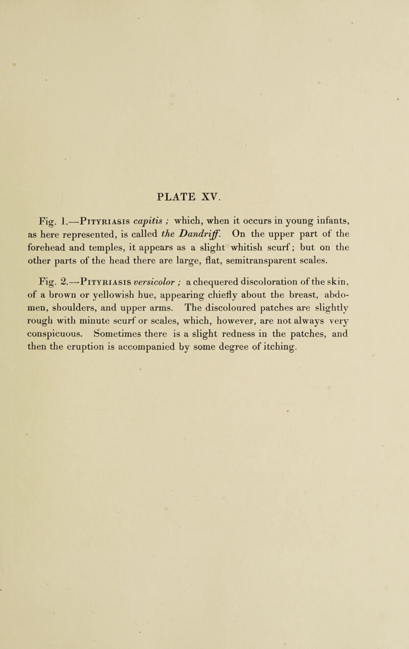 Fig. 1.—Pityriasis capitis ; which, when it occurs in young infants, as here represented, is called the Dandriff. On the upper part of the forehead and temples, it appears as a slight whitish scurf; but on the other parts of the head there are large, flat, semitransparent scales. Fig. 2.—Pityriasis versicolor ; a chequered discoloration of the skin, of a brown or yellowish hue, appearing chiefly about the breast, abdo¬ men, shoulders, and upper arms. The discoloured patches are slightly rough with minute scurf or scales, which, however, are not always very conspicuous. Sometimes there is a slight redness in the patches, and then the eruption is accompanied by some degree of itching.