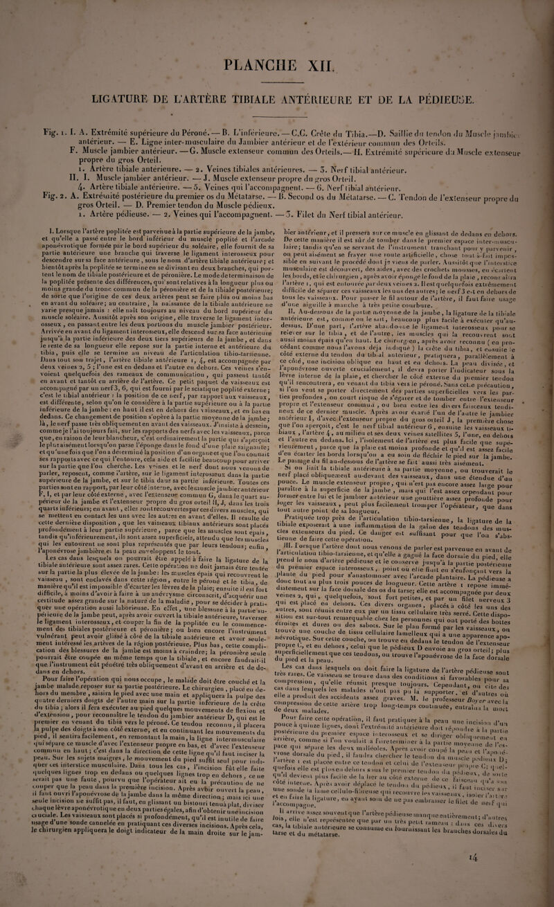LIGATURE DE L’ARTÈRE TIBIALE ANTÉRIEURE ET DE LA PÉDIEUSE. Fig1. i. I. A. Extrémité supérieure du Péroné. — B. L’inférieure. — C,G. Crète du Tibia.—D. Saillie du tendon du Muscle jambû. . antérieur. — E. Ligne inter-musculaire du Jambier antérieur et de l’extérieur commun des Orteils. F. Muscle jambier antérieur. —G. Muscle extenseur commun des Orteils.— IL Extrémité supérieure du Muscle extenseur propre du gros Orteil. 1. Artère tibiale antérieure. — 2. Veines tibiales antérieures. — 3. Nerf tibial antérieur. II. I. Muscle jambier antérieur. -— J. Muscle extenseur propre du gros Orteil, 4. Artère tibiale antérieure. —5. Veines qui l’accompagnent. — G. Nerf tibial anterieur, Fig. 2. A. Extrémité postérieure du premier os du Métatarse. — IL Second os du Métatarse. — C. Tendon de l’extenseur propre du gros Orteil. — D. Premier tendon du Muscle pédieux. 1. Artère pédieuse. — 2. Veines qui l’accompagnent. —3. Filet du Nerf tibial antérieur. I. Lorsque l’artère poplitée est parvenue à la partie supérieure de la jambe, et qu’elle a passé entre le bord inférieur du musclé poplité et l’arcade aponévrotique formée par le bord supérieur du soléaire, elle fournit de sa partie antérieure une branche qui traverse le ligament inlerosscux pour descendre sursa face antérieure , sous le nom d’artère tibiale antérieure ; et bientôtaprès lapoplitée se termineen se divisant eu deux branches, qui por¬ tent le nom de tibiale postérieure et de péronière. Le mode de terminaison de la poplitée présente des différences, qui'sont relatives à la longueur plus ou moins grande du tronc, commun de la péronière et de la tibiale postérieure; de sorte que l’origine de ces deux artères peut se faire plus ou moins bas en avant du soléaire; au contraire, la naissance de la tibiale antérieure ne yarie presque jamais : elle naît toujours au niveau du bord supérieur du muscle soléaire. Aussitôt après son origine, elle traverse le ligament inter¬ osseux , en passant entre les deux portions du muscle jambier postérieur. Arrivée en avant du ligament interosseux, elle descend sur sa face antérieure jusqu’à la partie inférieure des deux tiers supérieurs de la jambe, et dans Je reste de sa longueur elle repose sur la partie interne et antérieure du tibia, puis elle se termine au niveau de l’articulation tibio-tarsieune. Dans tout son trajet, l’artère tibiale antérieure 1, 4, est accompagnée par deux veines 2, 5 ; l’une est en dedans et l’autre en dehors. Ces veines s’en¬ voient quelquefois des rameaux de communication , qui passent tantôt en avant et tantôt en arrière de l’artère. Ce petit paquet d.e vaisseaux est accompagné par un nerf 3, 6, qui est fourni par le sciatique popiité externe • c’est le tibial antérieur : la position de ce nerf, par rapport aux vaisseaux est différente, selon qu’on le considère à la partie supérieure ou à la partie inférieure de la jambe: en haut il est en dehors des vaisseaux, et en bas eu dedans. Ce changement de position s'opère à la partie moyenne de la jambe- là, le nerf passe très obliquement en avant des vaisseaux. J’insiste à dessein* comme je l’ai toujours fait, sur les rapports des nerfs avec les vaisseaux, parce que, en raison de leur blancheur, c’est ordinairement la partie qui s’aperçoit le plusaisément lorsqu’on passe l’éponge dans le fond d’une plaie saignante- et qu’une fois que l’on a déterminé la position d’un organe et que l’on cou nuit ses rapportsavec cequi l’entoure, cela aideet facilite beaucoup pour arriver sur la partie que l’on cherche. Les vaines et le nerf dont nous venons de parler,, reposent, comme i’artère, sur le ligament intej-osseux dans la partie supérieure de la jambe, et sur le tibia daus sa partie inférieure. Toutes ces parties sont en rapport, par leur côté interne, avec le muscle jambier antérieur F, I, et parleur côté externe, avec l'extenseur commun G, dans le ruari su¬ périeur de la jambe et l’extenseur propre du gros orteil H, J, dansées trois quarts inférieurs; en avant, elles sonlrecouvertespar ces divers muscles qui se mettent eu contact les uns avec les autres en avant d’elles. Il résulté de cette dernièie disposition , que les vaisseaux tibiaux antérieurs sont placés profondément à leur partie supérieure, parce que les muscles sont épais tandis qu’inférieurement,ils sont assez superficiels, attendu que les muscles qui les entourent 11e sont plus représentés que par leurs tendons - enfin^ l’aponévrose jambière ei la peau enveloppent le tout. ’ ’ Les cas dans lesquels on pourrait être appelé à faire la ligature de la tibiale antérieure sont assez rares. Celle opération ne doit jamais être tentée sur la partie la plus élevée de la jambe: les muscles épais qui recouvrent le vaisseau , sont enclavés dans celle légion, entre le péroné et le tibia de manière qu’il est impossible d’écarter les lèvres de la plaie; ensuite il est fort difficile, à moins d’avoir à faire à un anévrysme circonscrit, d’acquérir une certitude assez grande sur la nature de la maladie , pour se décider à prati¬ quer une opération aussi laborieuse. En effet, une blessure à la partie su- péiieure de Ja jambe peut, après avoir ouvert la tibiale antérieure, traverser le ligament interosseux, et couper la fin de lapoplitée eu le commence¬ ment des tibiales postérieure et péronière; ou bien encore l’instrument vulnérant peut avoir glissé à côté de la tibiale antérieure et avoir seule¬ ment intéressé les artères de la région postérieure. hier antérieur, et il pressera sur ce muscle en glissant de dedans en dehors. De celte manière il est sûr de tomber dans le premier espace inter-muscu¬ laire; tandis qu’en se servant de l’instrument tranchant pour y parvenir ou peut aisément se frayer une route artificielle, chose tout à-fait impos¬ sible en suivant le procédé dont je viens de parler. Aussitôt que l’interstice musculaire est découvert, des aides, avec des crochets mousses, en écartent les bords, et le chirurgien , après avoir épongé le fond de la plaie , reconr aura l’artère i, qui est entourée par deux veines 2. Il est quelquefois extrêmement difficile de séparer ces vaisseaux les uns des autres; le neif 3 e-t en dehors de tous les vaisseaux. Pour passer le fil autour de i’artère, il faut faite usage d’une aiguille à manche à très petite courbure. IL Au-dessous de la paitie moyenne de la jambe, la ligature de la tibiale antérieure est, comme on le sait, beaucoup plus facileà exécuter qu’au- dessus. Dune part, tarière abandonne le ligament interosseux pour se relever sur le tibia, et de l’autre, les muscles qui la recouvrent sont aussi moins épais qu’en haut. Le chirurgien, après avoir leconnu ( en pro¬ cédant comme nous l’avons déjà indiqué) la ciête du tibia, et ensuite le côté externe du tendon du tib.al anterieur, pratiquera, parallèlement à ce côté, une incision oblique eu haut et en dehois. La peau divisée , et l’aponévrose ouverte crucialemerit, d devra porter l’indicateur sous’ la le vie interne de la plaie, et chercher le côté externe du premier tendon qu’il rencontrera, en venant du tibia veisie péroné. Sans cet,e piécaution si Ion veut se porter directement des parties superficielles vers les par¬ ties profondes , on court risque de s’égarer et de tomber entre l’extenseur propre et l’extenseur commun , ou bien entre les divers faisceaux tendi¬ neux de ce dernier muscie. Après avoir écarté l’un de l’autre le jambier antérieur I, d’avec l’cxteuseur propie du gros orteil J, la première chose que 1 on aperçoit, c’est le nerf tibial antérieur 6, ensuite les vaisseaux ti¬ biaux , l’artère 4, au milieu et ses deux veines satellites 5, l’une, en dehois et 1 autre eu dedans. Ici , l’isolement de l’artère est plus facile que supé¬ rieurement , parce que la plaie est moins profonde et qu’il est assez facile d en ccaiter les bords lorsqu’on a eu soin de fléchir le pied sur la jambe Le passage du fil au-dessous de l’artère se fait aussi très aisément. Si ou liait la tibiale antérieure à sa partie moyenne, ou trouverait le net. piaceobliqueme.it au-devant des vaisseaux, dans une étendue d’uu pouce. Le muscle extenseur propre, qui n’est pas encore assez large pour parailre a la superficie de la jambe , mais qui l’est assez cependant pour tonner entre lui et le jambier antérieur une gouttière assez profonde pour oger les vaisseaux, peut plus facilement tromper l’opéiateur, que dans tout autre point de sa longueur. * Pratiquée trop près de l’articulation tibio-tarsienue, la ligature de la tibiale exposerait à une inflammation de la gaine des tendons des mus¬ cles extenseurs du pied. Ce danger est suffisant pour que l’on s’abs¬ tienne de faire cette opération. 1 JH- I orsque l’artère dont nous venons de parler est parvenue en avant de I articulation iib.o-ta,sienne, et qu’elle a gagné la face dorsale du pied elle prend le nom d artère pedieuse et le conserve jusqu’à la partie postérieure du premier espace interosseux, point où elle finit en s’enfonçant vers la p ante du pied pour s anastomoser avec l’arcade plantaire. La pédieuse a donc tout au plus trois pouces de longueur. Cette artère r repise im.né- îateinent sur la face dorsale des os du tarse; elle est accompagnée par deux veines 2, qui , quelquefois, sont fort petkes, et par un fiS SirveuX 3 qui est place eu dehors. Ces divers organes, placés, à côté les uns des autres, sont réunis entre eux par un tissu cellulaire très serré. Celte disno Mt.ou est sur-tout remarquable chez les personnes qui ont porté des boues tûmes et dures ou des sabots. Sur le plan formé par les vaisseaux Z';?- Ue SC0UCl,'; de tisf‘ cellului,e '-“Ile, qui aLne aupl“ “ce 011 <*•<!*- le «eodo» de IwJE, du pied et la peau, très m,CoS ra,‘S leSqUels 0,1 doit,faire la ligure de l’artère pédieuse sont (jeva,^(;ause.ti'ouveda,,S(Jcs conditions si favorables nom- , . , . , . , éSion Postérieure. Plus bas , cette cornplr- Propre C, et en dehors , celui que’lë“pédiëu7D ^ ‘ex.l,cns®ur cation des blessures de la jambe est moins a craindre; la péronière seule superficiellement que ces tendons, ou trouve l’aponév ose dfh G 5 P T pourrait etre coupee en meme temps que la tibiale, et encore faudrait-il du Pied et la nom. ; aponevtose de la face dorsale que l’instrument eût pénétré très obliquement d’avant en arrière et de de¬ dans eri dehors. . Pour faire l’opération qui nous occupe , le malade doit être couché et la jambe malade reposer sur sa partie postérieure. Le chirurgien , placé en de- hors du membre , saisira le pied avec une main et appliquera la pulpe des quatre derniers doigts de l’autre main sur la partie inférieure de la cèle du tibia ; alors il fera exécuter au pied quelques mouvements de flexion et d extension, pour reconnaître le tendon du jambier antérieur D qui est le premier en venant du tibia vers le péroné. Ce tendou reconnu* il placera la pulpe des doigts a son cote externe, et en continuant les mouvements du pied, ,1 seiH.ra facilement, en remontant la main, la ligne intermusculaire qut séparé ce muscle d avec 1 extenseur propre en bas, et d’avec l’extenseur commun en haut ; c est dans la direction de cette ligne qu’il faut inciser la peau. Sur les sujets maigres, le mouvement du pied suffit seul pour indi¬ quer cet interstice musculaire. Dans tous les cas, l’incision fût elle faite quelques lignes trop en dedans ou quelques lignes trop en dehors ce ne •serait pas une faute pourvu que l’opérateur ait eu la précaution de ne couper que la peau dans la première incision. Après avbir ouvert la peau, il faut o 11 vri 1 aponévrose de la jambe dans la même direction ; mais ici une .seule incision ne suffit pas, fl faut, en glissant un bistouri tenuàplat diviser chaque levreaponevrot.queen deux parties égales, afin d’obtenir u.ieincision ci uciale. Les vaisseaux sont placés si profondément, qu’il est inutile de fuie usage d une sonde cannelée en pratiquant ces diverses incisions. Après cela Je chirurgien appliquera le doigt indicateur delà main droite surlcjam- co.npression, qu’elle réussit presque toujours. CepeîtTant^o» cUodo* cas dans lesquels les malades n’ont pas pu la supporter et ' elle a produit des accidents assez graves.^ M. le professeur 4 eravecb d e ' d e ux ^ ! n a I a d e s\ arlCre Ü°P lo,,6'leniPs continuée, entraîna la mort Four faire cette opération, il faut pratiquer à la peau une inrisim, P... pouce a quinze lignes, dont l’extrémité antérieure doit répondre à | , u.lir ' Poster,cure du p,emier espace iule,osseux et se dirige/ oblicn.em^t o,? ameie, comme si loti voulait,a f lire ter miner à la partie moviumn l l r * pace qui sépmc les deux malléoles. Après avoir coupé la pPu, ct °*3 v-o;se dorsale du pied, il faudra chercher le tendon du muSde péd e, x ï)0‘ aneie 1 est placée entie ce tendon et celui de l’extenseur nroo e (’• , q’ quefots elle est pinson dehors suis le premier tendon d 1 o- l J V q'ie * ?.».ilI |»u. facile ,1e la her au Lé mÙ™2 ce «o.e inlerue. Après avoir déplacé le tendon du pédieux i1 f.  Ml unesoede la la'eecelU'o-abre'Ueqni.eei.uvre L vaisseaux', isoleL’a', it ■ rwm^rure’ e“ a‘ SO,,‘ d°  'e «lit a. ^1 L arrive assez souvcntque l’artère pédieuse manque entièrement. r , ri? 7si re!,™‘c,uM s- !-■ m« né, peu, il;:, : d ,::: % z « du maS!rC  C°'‘S'‘,UU “ faU‘‘'iaSa'“ '« b«»cl«. dorsales du