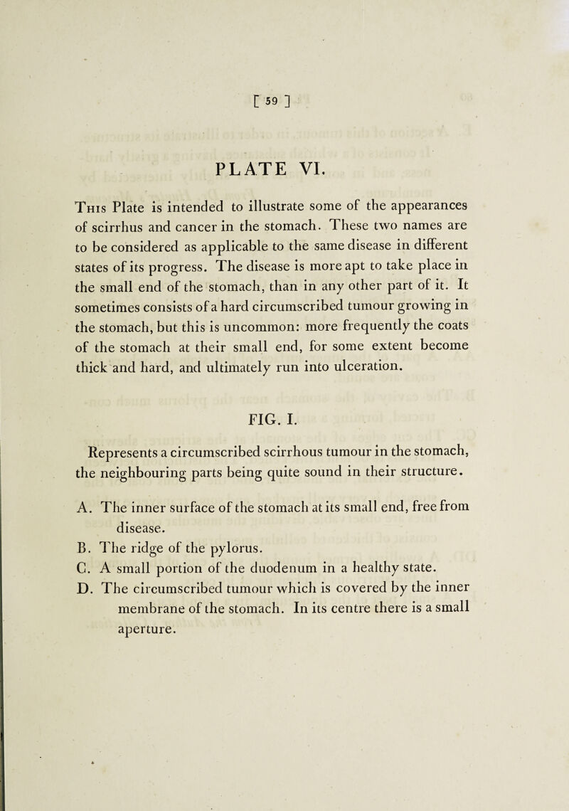 PLATE VL This Plate is intended to illustrate some of the appearances of scirrhus and cancer in the stomach. These two names are to be considered as applicable to the same disease in different states of its progress. The disease is more apt to take place in the small end of the stomach, than in any other part of it. It sometimes consists of a hard circumscribed tumour growing in the stomach, but this is uncommon: more frequently the coats of the stomach at their small end, for some extent become thick and hard, and ultimately run into ulceration. FIG. I. Represents a circumscribed scirrhous tumour in the stomach, the neighbouring parts being quite sound in their structure. A. The inner surface of the stomach at its small end, free from disease. B. The ridge of the pylorus. C. A small portion of the duodenum in a healthy state. D. The circumscribed tumour which is covered by the inner membrane of the stomach. In its centre there is a small aperture.
