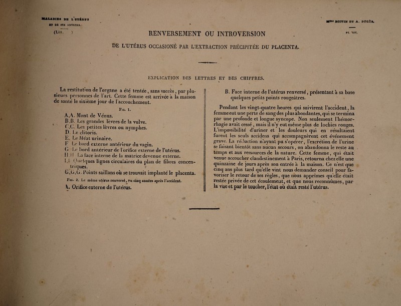 Mm» BOIVIN ET A. DCQ±*. LADIES de l dtéros ET DI SCS ANNEZRl. (Litt. ) RENVERSEMENT OU INTROVERSION DE L'UTÉRUS OCCASIONÉ PAR L’EXTRACTION PRÉCIPITÉE DU PLACENTA. vi. *xir. EXPLICATION DES LETTRES ET DES CHIFFRES. La restitution de 1 organe a été tentée, sans succès , par plu¬ sieurs personnes de 1 art. Cette femme est arrivée à la maison de santé le sixième jour de l'accouchement. Fig. 1. A, \- Mont de Vénus. B, B. Ces grandes lèvres de la vulve. ( ,C. Les petites lèvres ou nymphes. D. Le clitoris. E. Le Méat urinaire. F Le bord externe antérieur du vagin. C Le bord antérieur de 1 orifice externe de l’utérus, il > ’ La lace interne de la matrice devenue externe. 1,1 f.bwbjues lignes circulaires du plan de fibres concen¬ triques. i L,C,G. Points saillansoù se trouvait implanté le placenta. Fig. 2. Le même utérus renversé, ru cinq années après l’accident. V. Orifice externe de l’utérus. B. Face interne de l’utérus renversé, présentant à sa base quelques petits points rougeâtres. • Pendant les vingt-quatre heures qui suivirent l’accident, la femme eut une perte de sang des plus abondantes, qui se termina par une profonde et longue syncope. Non seulement l’hémor¬ rhagie avait cessé , mais il n’y eut même plus de lochies rouges. L’impossibilité d’uriner et les douleurs qui en résultaient furent les seuls accidens qui accompagnèrent cet événement grave. La réduction n’ayant pu s’opérer, l’excrétion de l’urine se faisant bientôt sans aucun secours, on abandonna le reste au temps et aux ressources de la nature. Cette femme, qui était venue accoucher clandestinement à Paris, retourna chez elle une quinzaine de jours après son entrée a la maison. Ce n’est que cincj ans plus tard qu’elle vint nous demander conseil pour fa¬ voriser le retour de ses règles, que nous apprîmes quelle était restée privée de cet écoulement, et que nous reconnûmes, par la vue et par le toucher, l’état où était resté l’utérus. t t* i