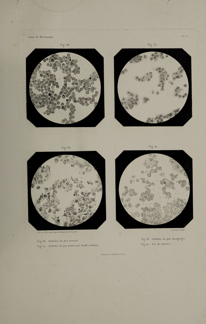 V Conrs (le .Vlit'roscopie. l’I. Fi O’. 36. ' Fiq’. 56. Globules do pus tioniial. Fi(2,-. 5-. Globules (le pus li-aitbs par l'acide ac('ti(iue Fi(il .58. Globules de pus désa(2’r(>^os. IGo; 4‘>. Fus ebaiiere. Public par J H. Haill ic.rc, raru