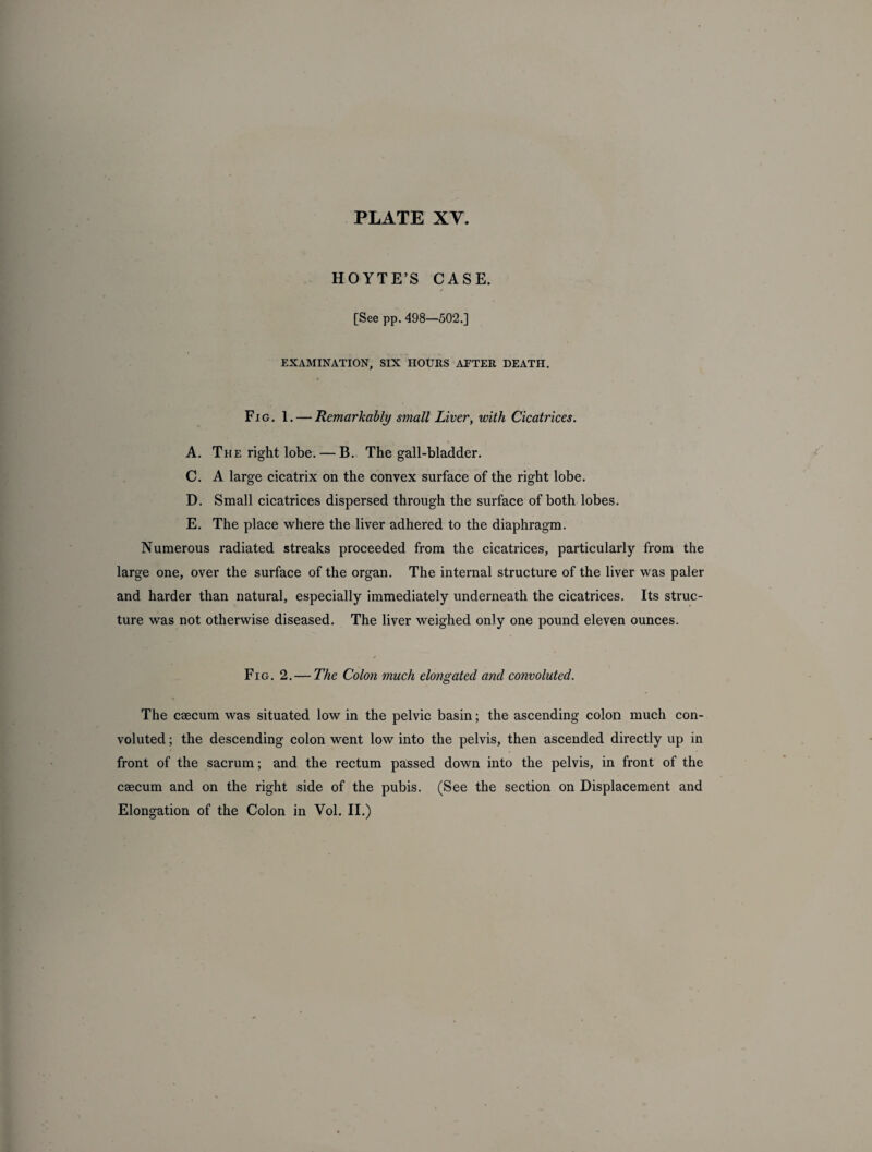 HOYTE’S CASE. [See pp. 498—502.] EXAMINATION, SIX HOURS AFTER DEATH. Fig. 1. — Remarkably small Liver, with Cicatrices. A. The right lobe. — B. The gall-bladder. C. A large cicatrix on the convex surface of the right lobe. D. Small cicatrices dispersed through the surface of both lobes. E. The place where the liver adhered to the diaphragm. Numerous radiated streaks proceeded from the cicatrices, particularly from the large one, over the surface of the organ. The internal structure of the liver was paler and harder than natural, especially immediately underneath the cicatrices. Its struc¬ ture was not otherwise diseased. The liver weighed only one pound eleven ounces. Fig. 2. — The Colon much elongated and convoluted. The caecum was situated low in the pelvic basin; the ascending colon much con¬ voluted ; the descending colon went low into the pelvis, then ascended directly up in front of the sacrum; and the rectum passed down into the pelvis, in front of the caecum and on the right side of the pubis. (See the section on Displacement and Elongation of the Colon in Vol. II.)