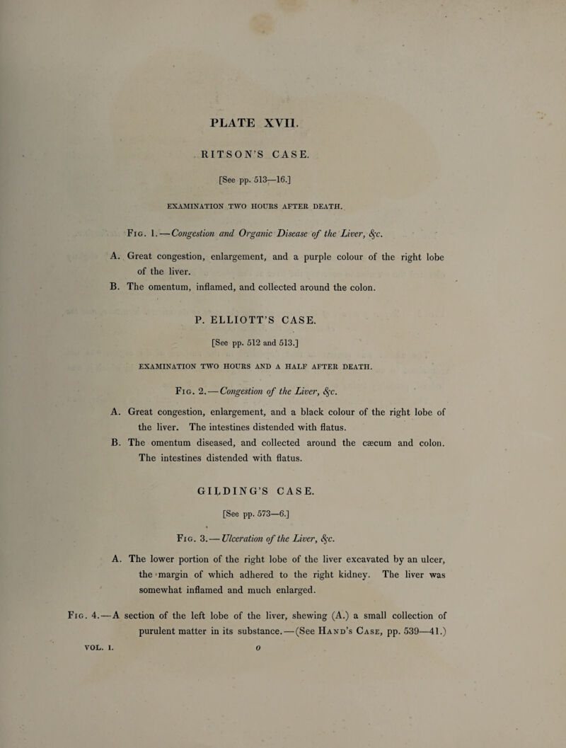 RITSON’S CASE. [See pp. 513—16.] EXAMINATION TWO HOURS AFTER DEATH. Fig. 1. — Congestion and Organic Disease of the Liver, S^c. A. Great congestion, enlargement, and a purple colour of the right lobe of the liver. B. The omentum, inflamed, and collected around the colon. P. ELLIOTT’S CASE. [See pp. 512 and 513.] EXAMINATION TWO HOURS AND A HALF AFTER DEATH. Fig. 2. — Congestion of the Liver, 8$c. A. Great congestion, enlargement, and a black colour of the right lobe of the liver. The intestines distended with flatus. B. The omentum diseased, and collected around the caecum and colon. The intestines distended with flatus. GILDING’S CASE. [See pp. 573—6.] % Fig. 3.— Ulceration of the Liver, fyc. A. The lower portion of the right lobe of the liver excavated by an ulcer, the-margin of which adhered to the right kidney. The liver was somewhat inflamed and much enlarged. Fig. 4. — A section of the left lobe of the liver, shewing (A.) a small collection of purulent matter in its substance. — (See Hand’s Case, pp. 539—41.) VOL. 1. O