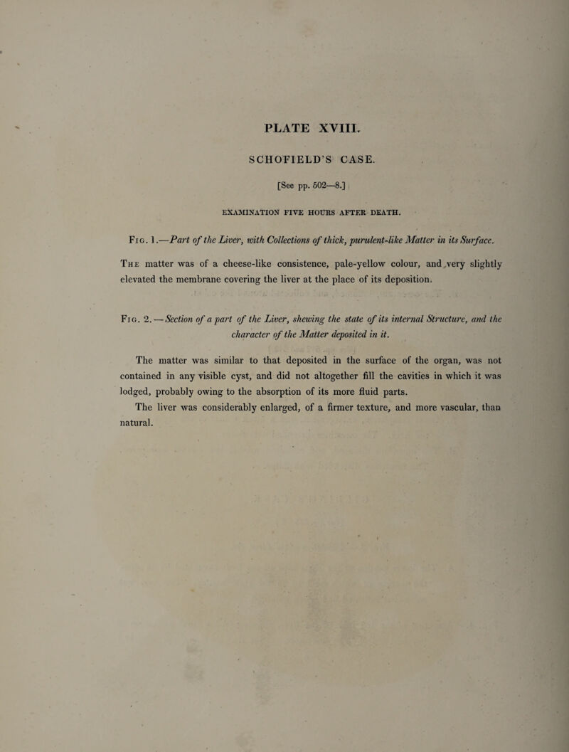 SCHOFIELD’S CASE. [See pp. 602—8.] EXAMINATION FIVE HOURS AFTER DEATH. Fig. 1.—Part of the Liver, with Collections of thick, purulent-like Matter in its Surface. The matter was of a cheese-like consistence, pale-yellow colour, and,very slightly elevated the membrane covering the liver at the place of its deposition. Fig. 2. — Section of apart of the Liver, shewing the state of its internal Structure, and the character of the Matter deposited in it. The matter was similar to that deposited in the surface of the organ, was not contained in any visible cyst, and did not altogether fill the cavities in which it was lodged, probably owing to the absorption of its more fluid parts. The liver was considerably enlarged, of a firmer texture, and more vascular, than natural.