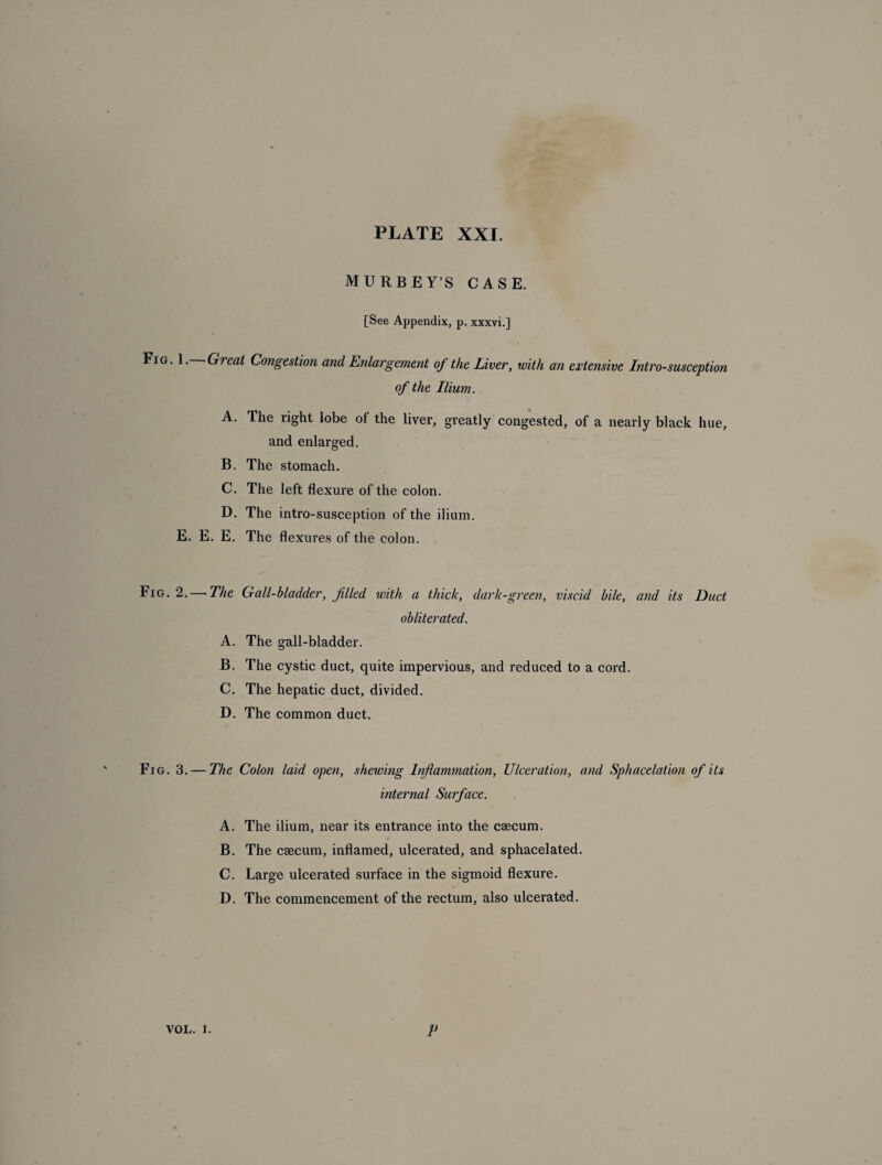 MURBEY’S case. [See Appendix, p. xxxvi.] Fig. 1. Great Congestion and Enlargement of the Liver, with an extensive Intro-susception of the Ilium. A. The right lobe of the liver, greatly congested, of a nearly black hue, and enlarged. B. The stomach. C. The left flexure of the colon. D. The intro-susception of the ilium. E. E. E. The flexures of the colon. Fig. 2.— The Gall-bladder, filed with a thick, dark-green, viscid bile, and its Duct obliterated. A. The gall-bladder. B. The cystic duct, quite impervious, and reduced to a cord. C. The hepatic duct, divided. D. The common duct. Fig. 3. — The Colon laid open, shewing Inflammation, Ulceration, and Sphacelation of its internal Surface. A. The ilium, near its entrance into the caecum. B. The caecum, inflamed, ulcerated, and sphacelated. C. Large ulcerated surface in the sigmoid flexure. D. The commencement of the rectum, also ulcerated. VOL. i. P