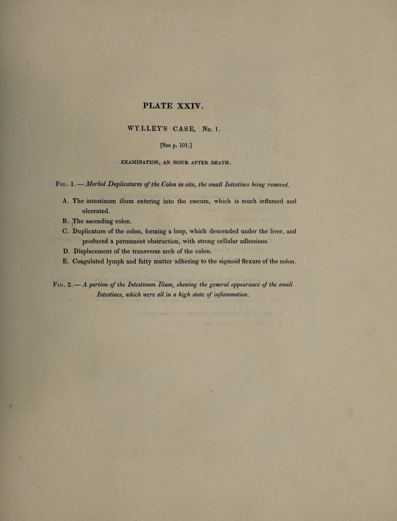 WYLLEY’S CASE. No. 1. [See p. 101.] EXAMINATION, AN HOUR AFTER DEATH. Fig. 1. — Morbid Duplicatures of the Colon in situ, the small Intestines being removed. A. The intestinum ilium entering into the caecum, which is much inflamed and ulcerated. B. The ascending colon. C. Duplicature of the colon, forming a loop, which descended under the liver, and produced a permanent obstruction, with strong cellular adhesions. D. Displacement of the transverse arch of the colon. E. Coagulated lymph and fatty matter adhering to the sigmoid flexure of the colon. Fig. 2. — A portion of the Intestinum Ilium, shewing the general appearance of the small Intestines, which were all in a high state of inflammation.
