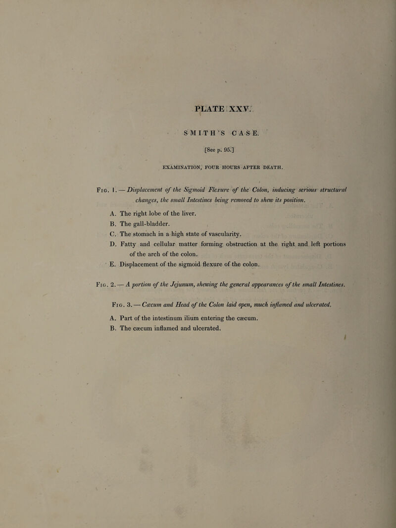SMITH’S CASE. [See p. 95.] EXAMINATION, FOUR HOURS AFTER DEATH. i Fig. I. — Displacement of the Sigmoid Flexure of the Colon, inducing serious structural changes, the small Intestines being removed to shew its position. A. The right lobe of the liver. B. The gall-bladder. C. The stomach in a high state of vascularity. D. Fatty and cellular matter forming obstruction at the right and left portions of the arch of the colon. E. Displacement of the sigmoid flexure of the colon. Fro. 2. — A portion of the Jejunum, shewing the general appearances of the small Intestines. Fig. 3. — Ccecum and Head of the Colon laid open, much inflamed and ulcerated. A. Part of the intestinum ilium entering the caecum. B. The caecum inflamed and ulcerated.