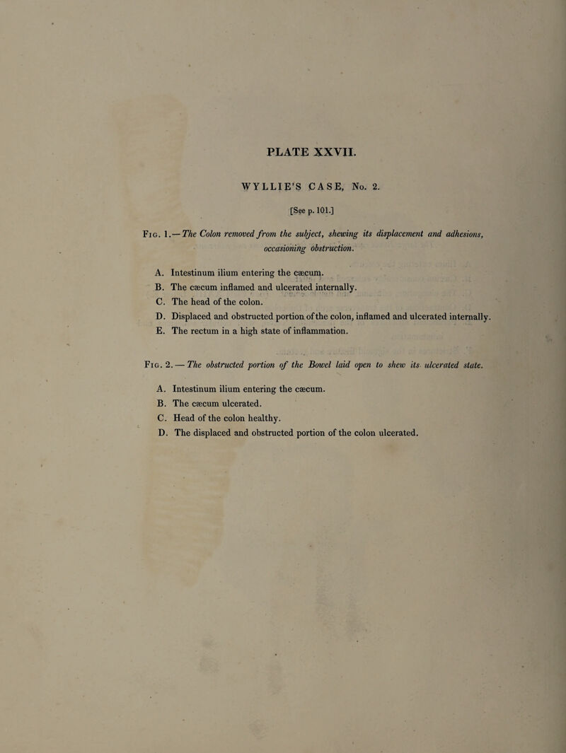WYLLIE’S CASE, No. 2. [See p. 101.] Fig. 1.— The Colon removed from the subject, shewing its displacement and adhesions, occasioning obstruction. A. Intestinum ilium entering the caecum. . I -a ' _ •' i* • .... . • - B. The caecum inflamed and ulcerated internally. C. The head of the colon. D. Displaced and obstructed portion of the colon, inflamed and ulcerated internally. E. The rectum in a high state of inflammation. Fig. 2.— The obstructed portion of the Bowel laid open to shew its ulcerated state. A. Intestinum ilium entering the caecum. B. The caecum ulcerated. C. Head of the colon healthy. D. The displaced and obstructed portion of the colon ulcerated.