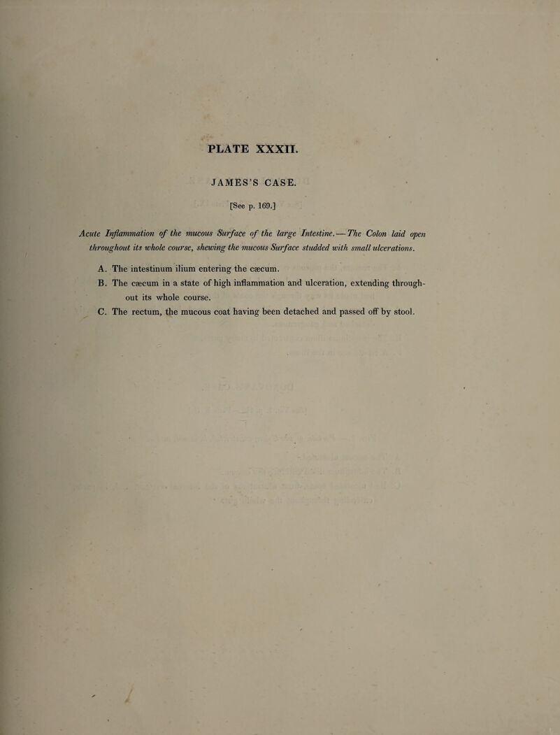 JAMES’S CASE. [See p. 169.] Acute Inflammation of the mucous Surface of the large Intestine. — The Colon laid open throughout its whole course, shewing the mucous Surface studded with small ulcerations. A. The intestinum ilium entering the caecum. B. The caecum in a state of high inflammation and ulceration, extending through¬ out its whole course. C. The rectum, the mucous coat having been detached and passed off by stool.