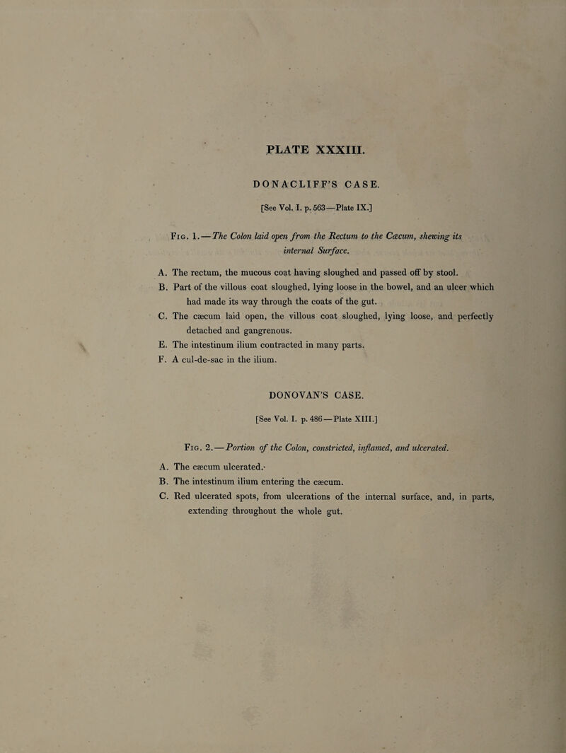 DONACLIFF’S CASE. [See Vol. I. p. 563—Plate IX.] Fig. 1. — The Colon laid open from the Rectum to the Caecum, shewing its internal Surface. A. The rectum, the mucous coat having sloughed and passed off by stool. B. Part of the villous coat sloughed, lying loose in the bowel, and an ulcer which had made its way through the coats of the gut. C. The caecum laid open, the villous coat sloughed, lying loose, and perfectly detached and gangrenous. E. The intestinum ilium contracted in many parts. F. A cul-de-sac in the ilium. DONOVAN’S CASE. [See Vol. I. p. 486—Plate XIII.] Fig. 2. — Portion of the Colon, constricted, inflamed, and ulcerated. A. The caecum ulcerated.* B. The intestinum ilium entering the caecum. C. Red ulcerated spots, from ulcerations of the internal surface, and, in parts, extending throughout the whole gut.