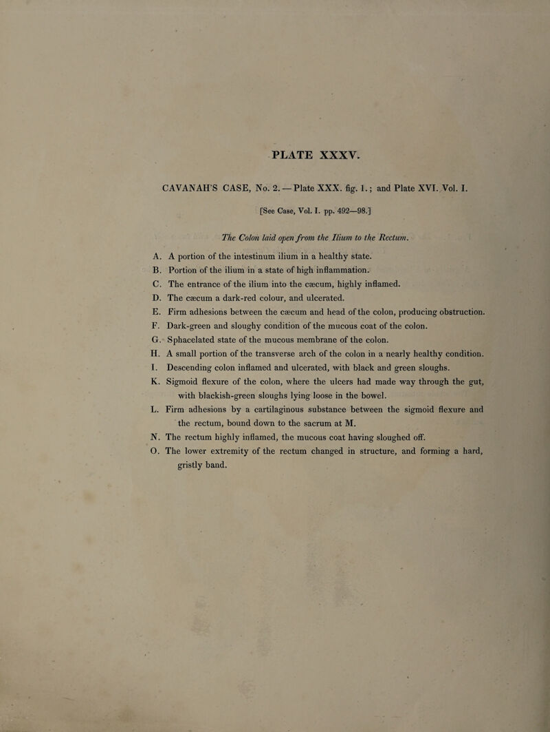 CAVANAH’S CASE, No. 2. —Plate XXX. fig. 1.; and Plate XVI. Vol. I. [See Case, Vol. I. pp. 492—98.] The Colon laid open from the Ilium to the Rectum. A. A portion of the intestinum ilium in a healthy state. B. Portion of the ilium in a state of high inflammation. C. The entrance of the ilium into the caecum, highly inflamed. D. The caecum a dark-red colour, and ulcerated. E. Firm adhesions between the caecum and head of the colon, producing obstruction. F. Dark-green and sloughy condition of the mucous coat of the colon. G. Sphacelated state of the mucous membrane of the colon. H. A small portion of the transverse arch of the colon in a nearly healthy condition. I. Descending colon inflamed and ulcerated, with black and green sloughs. K. Sigmoid flexure of the colon, where the ulcers had made way through the gut, with blackish-green sloughs lying loose in the bowel. L. Firm adhesions by a cartilaginous substance between the sigmoid flexure and the rectum, bound down to the sacrum at M. N. The rectum highly inflamed, the mucous coat having sloughed off. O. The lower extremity of the rectum changed in structure, and forming a hard, gristly band.