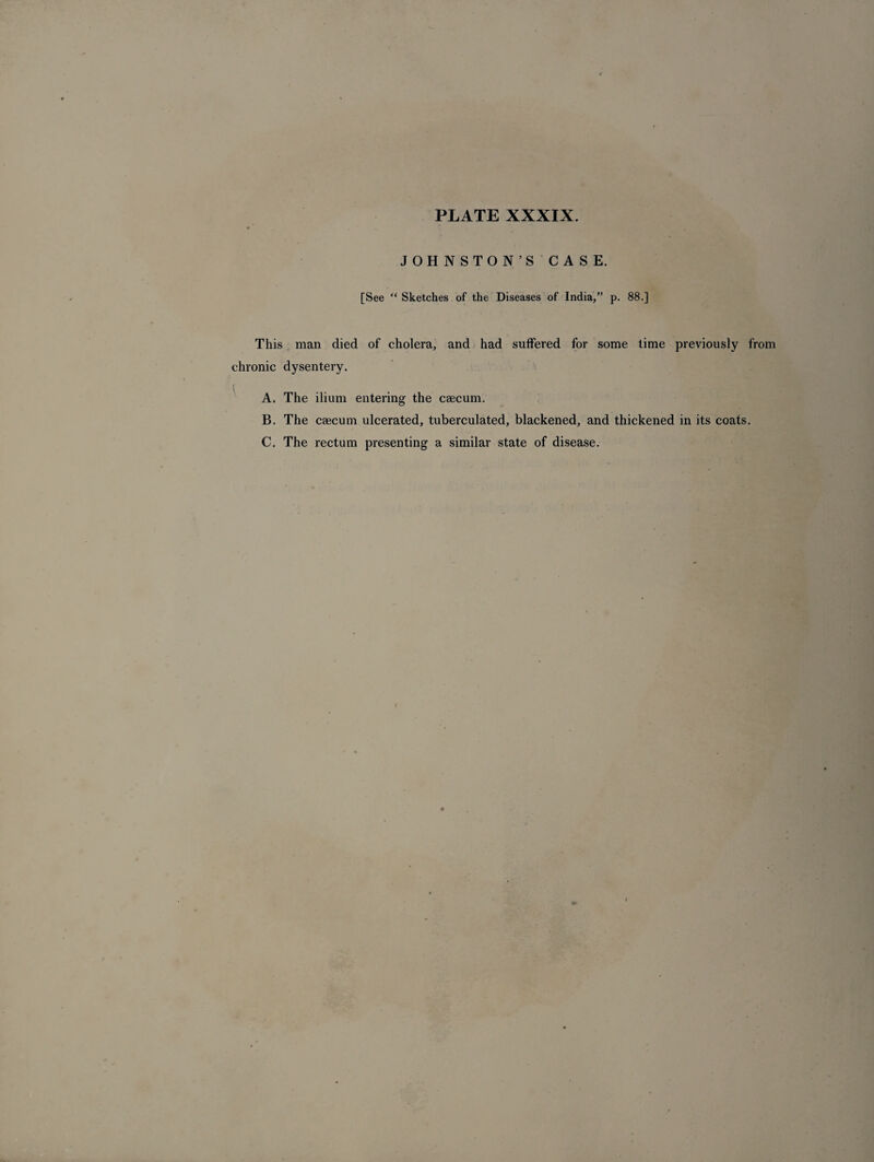 JOHNSTON’S CASE. [See “ Sketches of the Diseases of India,” p. 88.] This man died of cholera, and had suffered for some time previously from chronic dysentery. A. The ilium entering- the caecum. B. The caecum ulcerated, tuberculated, blackened, and thickened in its coats. C. The rectum presenting a similar state of disease.