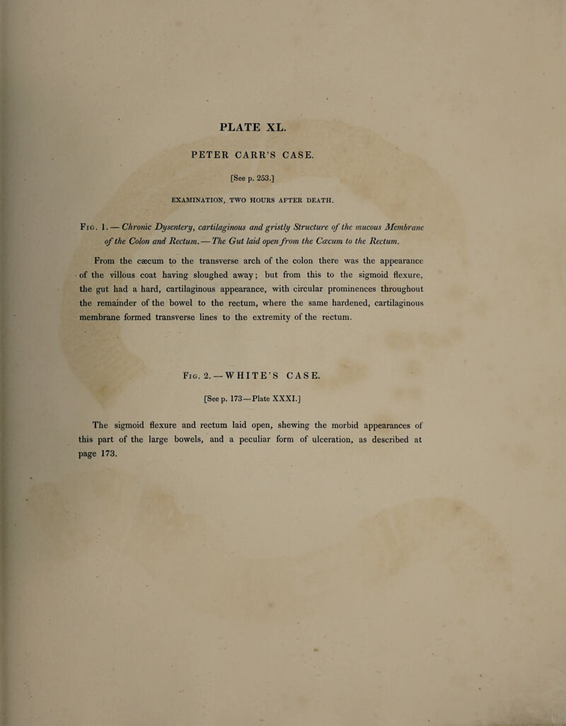 PLATE XL. PETER CARR’S CASE. [See p. 253.] EXAMINATION, TWO HOURS AFTER DEATH. Fig. 1. — Chronic Dysentery, cartilaginous and gristly Structure of the mucous Membrane of the Colon and Rectum. — The Gut laid open from the Caecum to the Rectum. From the caecum to the transverse arch of the colon there was the appearance of the villous coat having sloughed away; but from this to the sigmoid flexure, the gut had a hard, cartilaginous appearance, with circular prominences throughout the remainder of the bowel to the rectum, where the same hardened, cartilaginous membrane formed transverse lines to the extremity of the rectum. Fig. 2. —WHITE’S CASE. [Seep. 173 —Plate XXXI.] The sigmoid flexure and rectum laid open, shewing the morbid appearances of this part of the large bowels, and a peculiar form of ulceration, as described at page 173.