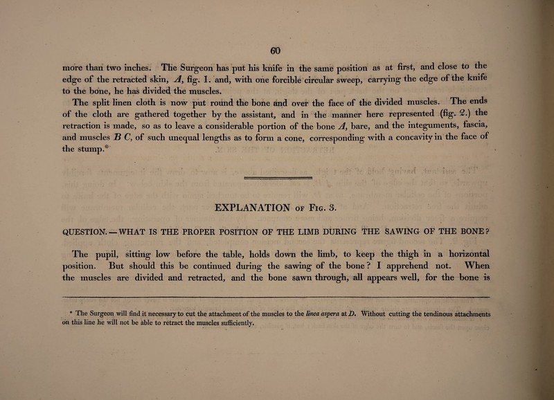 more than two inches. The Surgeon has put his knife in the same position as at first, and close to the edge of the retracted skin. A, fig. 1. and, with one forcible circular sweep, carrying the edge of the knife to the bone, he has divided the muscles. The split linen cloth is now put round the bone and over the face of the divided muscles. The ends of the cloth are gathered together by the assistant, and in the manner here represented (fig. 2.) the retraction is made, so as to leave a considerable portion of the bone A, bare, and the integuments, fascia, and muscles B C, of such unequal lengths as to form a cone, corresponding with a concavity in the face of the stump.* EXPLANATION of Fig. 3. QUESTION. — WHAT IS THE PROPER POSITION OF THE LIMB DURING THE SAWING OF THE BONE? The pupil, sitting low before the table, holds down the limb, to keep the thigh in a horizontal position. But should this be continued during the sawing of the bone? I apprehend not. When the muscles are divided and retracted, and the bone sawn through, all appears well, for the bone is * The Surgeon will find it necessary to cut the attachment of the muscles to the linea aspera at Z). Without cutting the tendinous attachments on this line he will not be able to retract the muscles sufficiently.