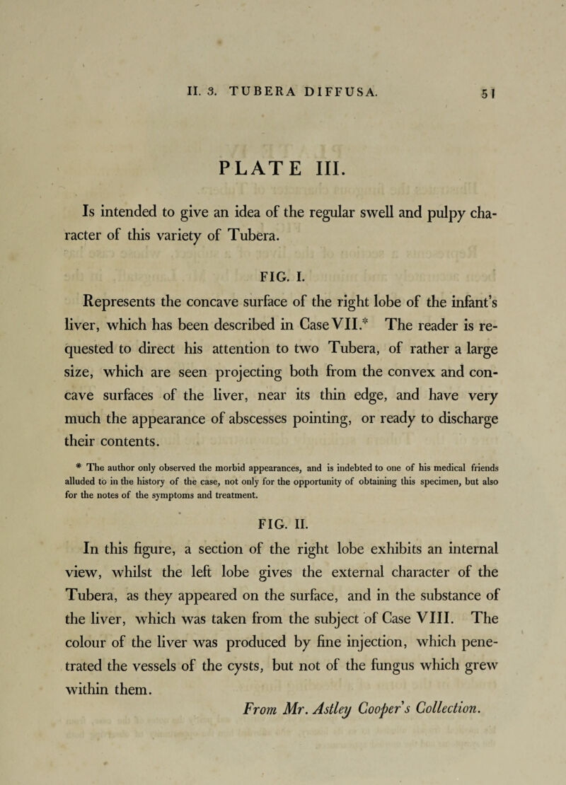 PLATE III. Is intended to give an idea of the regular swell and pulpy cha¬ racter of this variety of Tubera. FIG. I. Represents the concave surface of the right lobe of the infant’s liver, which has been described in Case VII.* The reader is re¬ quested to direct his attention to two Tubera, of rather a large size, which are seen projecting both from the convex and con¬ cave surfaces of the liver, near its thin edge, and have very much the appearance of abscesses pointing, or ready to discharge their contents. # The author only observed the morbid appearances, and is indebted to one of his medical friends alluded to in the history of the case, not only for the opportunity of obtaining this specimen, but also for the notes of the symptoms and treatment. FIG. II. In this figure, a section of the right lobe exhibits an internal view, whilst the left lobe gives the external character of the Tubera, as they appeared on the surface, and in the substance of the liver, which was taken from the subject of Case VIII. The colour of the liver was produced by fine injection, which pene¬ trated the vessels of the cysts, but not of the fungus which grew within them. From Mr. Astley Cooper s Collection.