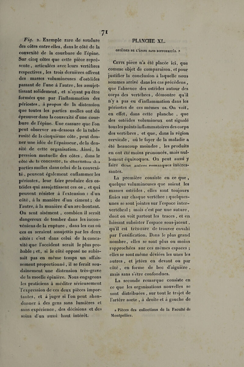 Fig. 2. Exemple rare de soudure des côtes entre elles, dans le côté de la convexité de la courbure de l’épine. Sur cinq côtes que cette pièce repré¬ sente , articulées avec leurs vertèbres respectives , les trois dernières offrent des masses volumineuses d’ostéïdes passant de l’une à l’autre, les assujet¬ tissant solidement, et n’ayant pu être formées que par l’inflammation des périostes , à propos de la distension que toutes les parties molles ont dû éprouver dans la convexité d’une cour¬ bure de l’épine. Une cassure que l’on peut observer au-dessous de la tubé¬ rosité de la cinquième côte , peut don¬ ner une idée de l’épaisseur, delà den¬ sité de cette organisation. Ainsi, la pression mutuelle des côtes , dans le côté de la concavité, la distension dca parties molles dans celui delà convexi¬ té, peuvent également enflammer les périostes, leur faire produire des os- téides qui assujettissent ces os , et qui peuvent résister à l’extension : d’un côté , à la manière d’un ciment ; de l’autre, à la manière d’un arc-boutant. On sent aisément , combien il serait dangereux de tomber dans les incon- véniens de la rupture , dans les cas où ces os seraient assujettis par les deux côtés : c’est dans celui de la conca¬ vité que l’accident serait le plus pro¬ bable ; et, si le côté opposé ne subis¬ sait pas en même temps un affais¬ sement proportionné, il se ferait sou¬ dainement une distension très-grave de la moelle épinière. Nous engageons les praticiens à méditer sérieusement l’expression de ces deux pièces impor¬ tantes, et à juger si l’on peut aban¬ donner à des gens sans lumières et sans expérience, des décisions et des soins d’un aussi haut intérêt. PLANCHE XL. ostéides de l’épine sans difformités, a Cette pièce n’a été placée ici, que comme objet de comparaison, et pour justifier la conclusion à laquelle nous sommes arrivé dans les cas précédens , que l’absence des ostéides autour des corps des vertèbres , démontre qu’il n’y a pas eu d’inflammation dans les périostes de ces mêmes os. On voit, en effet, dans cette planche , que des ostéides volumineux ont signalé tousles points inflammatoires des corps des vertèbres , et que, dans la région cervicale , où le foyer de la maladie a été beaucoup moindre , les produits en ont été moins prononcés, mais nul¬ lement équivoques. On peut aussi y faire cIcuk autres ramarijucs intéres¬ santes. La première consiste en ce que , quelque volumineuses que soient les masses ostéides , elles sont toujours finies sur chaque vertèbre : quelques- unes se sont jointes sur l’espace inter¬ vertébral ; mais c’est par une suture , dont on voit partout les traces , et en laissant subsister l’espace sous-jacent, qu’il est très-rare de trouver envahi par l’ossification. Dans le plus grand nombre, elles se sont plus ou moins rapprochées sur ces mêmes espaces ; elles se sont même déviées les unes les autres , et jetées en devant ou par côté , en forme de bec d’aiguière , mais sans s’étre confondues. La seconde remarque consiste en ce que les organisations nouvelles se sont distribuées , sur tout le trajet de l’artère aorte , à droite et à gauche de a Pièces des collections de la Faculté de Montpellier.