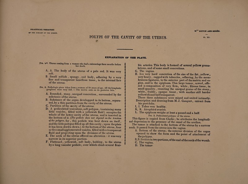 OF THE DISEASES OF THE UTERUS. Mm' EOIVIN AND DUOÈS. POLYPI OF THE CAVITY OF THE UTERUS- X EXPLANATION OF THE PLATE. Fig. l'. Uterus coming from a woman who had a miscarriage three months before her death. A, A. The body of the uterus of a pale red. It was very soft. B. Small softish , spungy , red body, adhering by a very fine and transparent lamellous tissue, to the internal face of the uterus. FiG. 2. Pathologic piece taken from a woman of 70 years of age. All the lymphatic ganglions were very full. — The matrix, seen on its posterior face. A. Rounded, stony, unequal concretion, surrounded by the substance of the uterus. B. Substance of the organ developped in its bottom, separa¬ ted, by a thin partition from the cavity of the uterus. C. Partition of the cavity of the uterus. D. A pediculated vesiculous,soft polypus, ^containing many little vesicles, filled with a yellowish fluid) occupies the whole of the lower cavity of Ihe uterus, and is inserted in the bottom of it. (The pedicle does not depend on the traction of the polypus, for , this pedicle was bent down on itself, and the little polypus filled up all this cavity ; upon the plate it has been drawn down.) At the bottom of the uterus, four or five small agglomerated vesicles, filled with a transparent fluid and projecting upon the divisions of the uterus. E. The neck of the uterus offered no alteration : it was very narrow in its superior portion. F. Flattened, yellowish, soft body, holding, to the uterus by a long vascular pedicle ; over which climb several flexi- v ble arteries. This body is formed of several yellow granu- \ lations, and of some small concretions, ♦ G. The vagina. ! H. Isa very hard concretion of the size of the fist, yellow * I very heavy , rugged with tubercles , adhering, by the mem- | branous ligatures, to the anterior part of the matrix and va- I gina » and to the epiploom. This large tumor, sawed , oflfe- | red a composition of very firm, white, fibrous tissue, in | small quantity , reuniting the unequal grains of the stony, | white, friable opaque tissue , with another still harder I yellowish and half transparent. , § These three substances were mixed and united intimatly* I Description and drawing from M. J. Cloquet, extract from | his port-folio, f I, I. Tubes very healthy. | K, K. Atrophied ovaries. f L. The epiploom weighs at least a pound and a half. f Fig. 3. Pediculated polypus of the uterus. This figure is copied from Clarke ; he attributes the longitudi- * nal depression to the presence of the canal of the urethra. I The tumor is attached to the bottom of the uterus by a narrow ! neck. It passed from the uterus into the vagina. $ A. Bottom of the uterus; the anterior division of the organ I opened to shew the form and the point of attachment of g the polypus. § B>B- Section in two portions, of the end of the neck of the womb. | C. The vagina. ' D. The tumor-