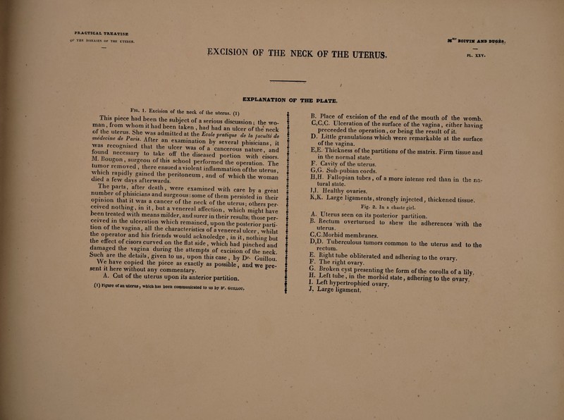 OK TilF, DISEASES OF THE UTERUS. SOI VIM AMD DUGÈS. *•, ' 71 i EXCISION OF THE NECK OF THE UTERUS. EXPLANATION OF THE PLATE. tiG. 1. Excision of the neck of the uterus. (1) Tills piece had been the subject of a serious discussion; the wo- man, from whom it had been taken , had had an ulcer of the neck of the 'derus She was admitted at the Ecole pratique de la faculté de ■medecnte de Pans. After an examination by several phisiclans 1 was recognised that the ulcer was of a Cancerous1 nature and M Rou“y diseased portion with cisors • o surgeon of this school performed the operation The tumor removed , there ensued a violent inflammation of the uterus diedCa f 7 ^r^ the Per,toneum > and of which the woman died a few days afterwards. The parts after death, were examined with care by a great number of plusicians and surgeous:some of them persisted in their opimon that it was a cancer of the neck of the uterus; others per¬ ceived nothing in it, but a venereal affection, which might have been treated with means milder, and surer in their results; those per- tiorl nf Ih lhC ulceratl01* which remained, upon the posterior parti¬ tion of the vagina, all the characteristics of a venereal ulcer whilst Jh® °Perator and hls friends would acknoledge , in it, nothing but the effect of cisors curved on the flat side , which had pinched and damaged the vagina during the attempts of excision of the neck Such are the details, given to us, upon this case , by Dr- Guillou We have copied the piece as exactly as possible, and we pre¬ sent it here without any commentary. v A. Cut of the uterus upon its anterior partition. (l) Figure of an uterus, which has been communicated to us by Dr. Guiuou. B. Place of excision of the end of the mouth of the womb. C, C,C. Ulceration of the surface of the vagina, either havin0, proceeded the operation, or being the result of it. D. Little granulations which were remarkable at the surface of the vagina. E, E. Thickness of the partitions of the matrix. Firm tissue and in the normal state. F. Cavity of the uterus. G, G. Sub-pubian cords. Il,H. b allopian tubes , of a more intense red than in the na¬ tural state. 1,1. Healthy ovaries. K,K. Large ligaments, strongly injected, thickened tissue. Fig. 2. In a chaste girl. A. Uterus seen on its posterior partition. B. Rectum overturned to shew the adhérences with the uterus. C, C.Morbid membranes. D, D. Tuberculous tumors common to the uterus and to the rectum. F. The right ovary. G. Broken cyst presenting the form of the corolla of a lily. t t ni,tube’m l,he morbid slate, adhering to the ovary. I. Lett hypertrophied ovary. J, Large ligament.