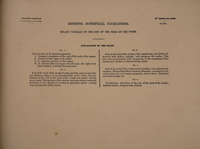 Ob' THE DISEASES OF THE UTERUS. EROSIONS, SUPERFICIAL ULCERATIONS, PL.-XX VI. MILIARY VESICLES OF THE END OF THE NECK OF THE WOMB. EXPLANATION OF THE PLATE* Fig. ll“. Fig. 3. Uuterus seen at its posterior partition’ A. Sanguine congestion of the end of the neck of the womb. B. Erosion of the edges of its orifice. C, C. Superior portion of the vagina. D, D. Recent little scars upon the left ovary, (the right ovary altho healthy, is double the usual size). Fig. 2. End of the neck of the womb of a lady aged 24, maried and with¬ out children subject to an abundant flow of the whites. The épi¬ thélium of the end of the neck of the womb was almost entirely worn away. This portion of the uterine neck was almost constantly bathed in a very abundant secretion of puriform matter , coming from the interior of the matrix» ! I * ! End of the neck of the womb of the natural size, of a lively red, strewed with miliary, whitish, soft vesicles on the surface. This state was accompanied with irregularity in the evacuation of the menses and emission of blood during coition. Fig. 4. | End of the neck of the womb much tumefied ; very extensive ul- | ceration ; Blennorhagic flow extremely abundant, accompanied by | violent pain and very serious symptoms, snch as fever , diarrhioea | and metrorrhagia etc. | Fig. 5. I | Tumefaction, ulceration of the end of the neck of the womb * | habitual whites, frequent loss of blood.