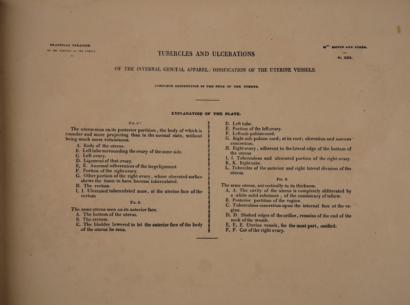 OK THE DISK ASKS OK THE UTERUS. TUBERCLES AND ULCERATIONS Mme BOIVIN AND EUGES, PL. XXIX. OF THE INTERNAL GENITAL APPAREL ; OSSIFICATION OF THE UTERINE VESSELS. COMPLETE DESTRUCTION OF THE NECK OF THE UTERUS* explanation of the plate. Fig. 1»'. ? 2 The uterus seen on its posterior partition , the body of which is I rounder and more projecting than in the normal state, without f being much more voluminous. I ♦ A. Body of the uterus. I B. Left tube surrounding the ovary of the same side. C. Left ovary. ? D. Ligament of that ovary. E. E. Anormal adherenices of the large ligament. F. Portion of the right ovary. G. Other portion of the right ovary, whose ulcerated surface j shews the tissue to have become tuberculated. £ H. The rectum. • I. I. Ulcerated tuberculated mass, at the uterine face of the | rectum | Fig. 2. § I The same uterus seen on its anterior face. | A. The bottom of the uterus. | B. The rectum. | C. The bladder lowered to let the anterior face of the body $ -of the uterus be seen. $ D. Left tube. E. Portion of the left ovary. F. Left sub-pubian cord. G. Right sub-pubian cord ; at its root ; ulceration and osseous concretion. H. Rightovary , adherent to the lateral edge of the bottom of the uterus I. I. Tuberculous and ulcerated portion of the right ovary. K, K. Right tube. L. Tubercles of the anterior and right lateral division of the uterus. Fig. 3. The same uterus, cut vertically in its thickness. A, A. The cavity of the uterus is completely obliterated by a white solid substance , of the consistency of tallow. B, Posterior partition of the vagina. C, Tuberculous concretion upon the internal face ot the va¬ gina. D, D. Slashed edges of the orifice, remains of the end of the neck of the womb. E, E, E. Uterine vessels, for the most part, ossified, F, F. Cut of the right ovary.