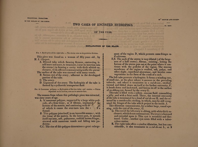 OF TUB DISEASES OF THE UTERUS. Mm* «OIVIN AND DUOÈ8» TWO CASES OF ENCYSTED HYDROPISIA OF THE TUBE. fl. xxxy. EXPLANATION OP THE PLATE. Fio. t. Hydropisia of the right tube. —The uterus seen on its posterior division. This piece was found on a woman of fifty years old , by M. J. Cloquet. A. Dilated tube which forming flexures, contracting it¬ self more and more, to terminate, ( near its insertion into the uterus) in forming a cavity with thick whitish en¬ closures, with cells not com municatingwiths the uterus. The surface of the tube was strewed with many vessels. B. Serous cyst of the ovary, adherent to the clevelopped portion of the tube. C. The ovary. D. Ligament of the ovary. The hydropisia of the lube is formed by a yellowish transparent fluid. FiG. 2. Cancerous polypus. — Hydropisia of the two tubes and ovaries. — Uterus depressed on its bottom, seen on its anterior face. The woman from whom this pathologic piece was extracted, was sixty years of age. A. A cancerous polypus, supported by a large white pédi¬ cule, of a firm tissue, as if fibrous, implanted ? ’he bottom of the matrix, and continuing with thr 1 A, of which it causes the over-turn into the ) *f a funnel. B. T1 iis polypus joins itself, in an insensible manner, with the tissue of the matrix. In the lower part., it spreads itself out into, soft, pultaceous, reddish brown fringes , strewed with numerous vessels and falling into pu- dritity. Iment of the vagina. D, which presents some fringes as if schirrous. E,E. The neck of the uterus is very dilated (of the large¬ ness of a half crown) , fibrous, resisting, letting the bottom of the uterus pass out at the point where it con¬ tinues with the pedicles of the vagina. The mucous membrane of the vagina is swelled, soft, pulpy, and offers slight, superficial ulcerations , and besides some vegetations in the form of the comb of a cock. | The left tube presents a hydropisia. It forms a winding cyst, I of small size , at the place where it answers to the preceding ! tubercle, and where it terminates in a cul-de-sac, swelled, | twisted and folded down on itself at the farther extremity, F, I it bends down and backward, and fastens its elf to the surface I of an oblong cyst, formed by the ovary G. This tube is filled with a yellow, mucous fluid, ressembling a jelly, and with a faint smell. There, the internal extremity of the tube is terminated by a kind of cul-de-sac H, and the ex¬ ternal by a considerable swelling, in which, may be still recog- | nised the fringes of the tube which project in the inside, I. | This dilatation communicates, by a rather large, round ope- f ning, with the cyst of the ovary, G. | G- The cyst of the left ovary is oblong, with white thick en¬ closures, which do not communicate. The ovary is fastened * and extended upon it. This cyst is wrinkled and flat— ? tened. Under, another cyst exists filled with a tuker- I culous matter. I K. The right tube offers a similar dilatation, but less con¬