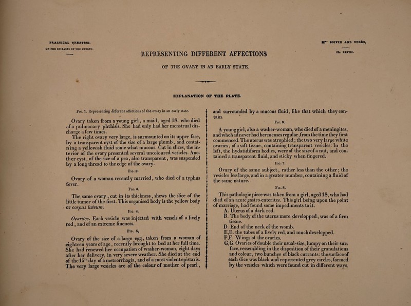 OF THE DISEASES OF TUE ÜTERDS. REPRESENTING DIFFERENT AFFECTIONS M' BOIVIN AND DOOiS; PL. XXXVII. OF THE OVARY IN AN EARLY STATE. EXPLANATION OF THE PLATE. Fig. 1. Representing different affections of the ovary in an early state. 4 Ovary taken from a young girl, a maid , aged 18. who died of a pulmonary phthisis. She had only had her menstrual dis¬ charge a few times. The right ovary very large, is surmounted on its upper face, by a transparent cyst of the size of a large plumb, and contai¬ ning a yellowish fluid some what mucous. Cut in slices, the in¬ terior of the ovary presented several uncoloured vesicles. Ano¬ ther cyst, of the size of a pea, also transparent, was suspended by a long thread to the edge of the ovary. Fig. 2. Ovary of a woman recently married, who died of a typhus fever. Fig. 3. The same ovary , cut in its thickness, shews the slice of the little tumor of the first. This organised body is the yellow body - or corpus luteum. Fig. 4. Ovarites. Each vesicle was injected with vessels of a lively red, and of an extreme fineness. Fig. 5, Ovary of the size of a large egg, taken from a woman of eighteen years of age, recently brought to bed at her full time. She had renewed her occupation of washer-woman, eight days after her delivery, in very severe weather. She died at the end of the 15th day of a metrorrhagia, and of a most violent épistaxis. The very large vesicles are of the colour of mother of pearl, i ? i ! ! i ! ! » » t 5 » i | f § ! i I I i and surrounded by a mucous fluid, like that which they con¬ tain. Fig. 6. A younggirl, also a washer-woman, who died of a méningites, and whoh ad never had her menses regular, from the time they first commenced. The uterus was atrophied ; the two very large white ovaries, of a soft tissue, containing transparent vesicles. In the left, the hydatidiform bodies, were of the size of a nut, and con¬ tained a transparent fluid, and sticky when fingered. Fig. 7. Ovary of the same subject, rather less than the other ; the vesicles less large, andin a greater number, containing a fluid of the same nature. Fig. 8. This pathologic piece was taken from a girl, aged 18, who had died of an acute gastro-enterites. This girl being upon the point of marriage, had found some impediments to it. A. Uterus of a dark red. B. The body of the uterus more developped, was of a firm tissue. D, End of the neck of the womb. E, E. the tubes of a lively red, and much developped. F, F. Wings of the ovaries. G, G. Ovaries of double their usual-size, lumpy on their sur¬ face, ressembling in the disposition of their granulations and colour, two bunches of black currants : the surface of each slice was black and represented grey circles, formed by the vesicles which were found cut in different ways.