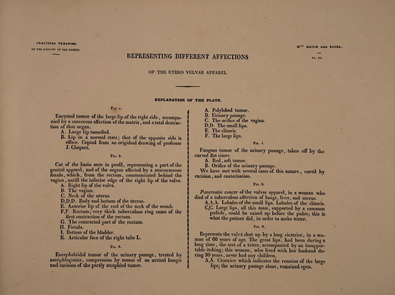 OF THE DISEASES OF THE OTEROS. Mnle BOIVIN AND DUGjfcS REPRESENTING DIFFERENT AFFECTIONS OF THE UTERO VULVAR APPAREL. EXPLANATION OF THE PLATE. Fig. i. ! Encysted tumor of the large lip of the right side, accompa- I nied by a cancerous affection of the matrix, and a total destruc- f tion of that organ. | A. Large lip tumefied. f B. Lip in a normal state ; that of the opposite side is | efface. Copied from an origidnal drawing of professor § J. Cloquet. I Fig. 2. | | Cut of the basin seen in profil, representing a part of the § genital apparel, and of the organs affected by a stercoraceous § fistula, which, from the rectum, communicated behind the I vagina, untill the inferior edge of the right lip of the vulva, f A. Right lip of the vulva. ® B. The vagina. I C. Neck of the uterus. | D. D,D. Cody and bottom of the uterus. f E. Anterior lip of the end of the neck of the womb. $ F. F. Rectum^very thick tuberculous ring cause of the f first contraction of the rectum. | G. The contracted part of the rectum. I IL Fistula. I I. Bottom of the bladder. | K. Articular face of the right tube L. § f Fig. 3. | • Encephaloïdal tumor of the urinary passage, treated by | ante'phlogistics, compression by means of an urelral bougie | and excision of the partly atrophied tumor. § A. Polylobed tumor. B. Urinary passage. C. The orifice of the vagina. D. D. The small lips. E. The clitoris. F. The large lips. Fig. 4. Fungous tumor of the urinary passage, taken off by the curved flat ci sors. A. Red, soft tumor. B. Orifice of the urinary passage. We have met with several cases of this nature , cured by excision, and cauterisation. Fig. 5. Pancreatic cancer of the vulvar apparel, in a woman who died of a tuberculous affection of lungs, liver, and uterus. A, A,A. Lobules of the small lips. Lobules of the clitoris. C. C. Large lips, all this mass, supported by a common pedicle, could be raised up before the pubis; this is what the patient did, in order to make water. Fig. 0. Represents the vulva shut up by a long cicatrice, in a wo¬ man of 66 years of age. The great lips, had been during a long time, the seat of a tetter, accompanied by an insuppor¬ table itching; this woman, who lived wilh her husband du¬ ring 30 years, never had any children. A,A. Cicatrice which indicates the reunion of the large lips; the urinary passage alone, remained open.