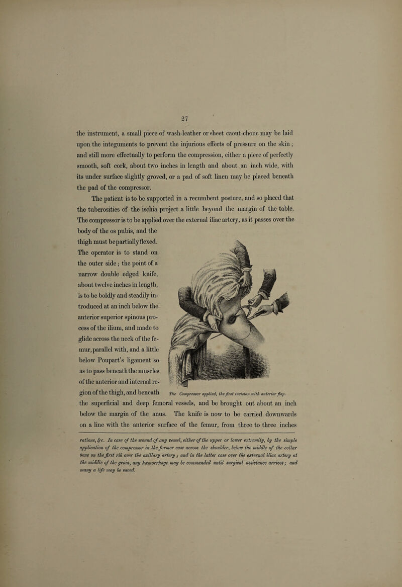 the instrument, a small piece of wash-leather or sheet caout-chouc may he laid upon the integuments to prevent the injurious effects of pressure on the skin ; and still more effectually to perform the compression, either a piece of perfectly smooth, soft cork, about two inches in length and about an inch wide, with its under surface slightly groved, or a pad of soft linen may be placed beneath the pad of the compressor. The patient is to be supported in a recumbent posture, and so placed that the tuberosities of the ischia project a little beyond the margin of the table. The compressor is to be applied over the external iliac artery, as it passes over the body of the os pubis, and the thigh must bepartially flexed. The operator is to stand on the outer side; the point of a narrow double edged knife, about twelve inches in length, is to be boldly and steadily in¬ troduced at an inch below the anterior superior spinous pro¬ cess of the ilium, and made to glide across the neck of the fe¬ mur, parallel with, and a little below Poupart’s ligament so as to pass beneat h the muscles of the anterior and internal re¬ gion of the thigh, and beneath the superficial and deep femoral vessels, and be brought out about an inch below the margin of the anus. The knife is now to be carried downwards on a line with the anterior surface of the femur, from three to three inches rations, Sfc. In case of the wound of any vessel, either of the upper or loicer extremity, by the simple application of the compressor in the former case across the shoulder, below the middle of the collar bone on the first rib over the axillary artery; and in the latter case over the external iliac artery at the middle of the groin, any luemorrhage may be commanded until surgical assistance arrives; and many a life may be saved. The Compressor applied, the first incision with anterior flap.