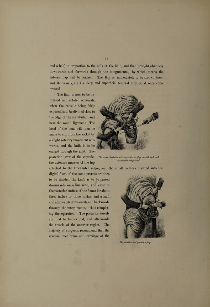 and a half, in proportion to the hulk of the limb, and then brought obliquely downwards and forwards through the integuments; by which means the anterior flap will be formed. The flap is immediately to be thrown back, and its vessels, viz. the deep and superficial femoral arteries, at once com¬ pressed The limb is now to be de¬ pressed and rotated outwards, when the capsule being fairly exposed, is to be divided close to the edge of the acetabulum and next the round ligament. The head of the bone will then be made to slip from the socket by a slight rotatory movement out¬ wards, and the knife is to be carried through the joint. The posterior layer of the capsule, The second incision, with the anterior flap carried back and . i p , 1 i • We vessels compressed. the extensor muscles ot the lnp attached to the trochanter major, and the small rotators inserted into the digital fossa of the same process are then to be divided, the knife is to be passed downwards on a line with, and close to the posterior surface of the femur for about three inches or three inches and a half, and afterwards downwards and backwards through the integuments,—thus complet¬ ing the operation. The posterior vessels are first to be secured, and afterwards the vessels of the anterior region. The majority of surgeons recommend that the synovial membrane and cartilage of the The anterior and posterior flaps.