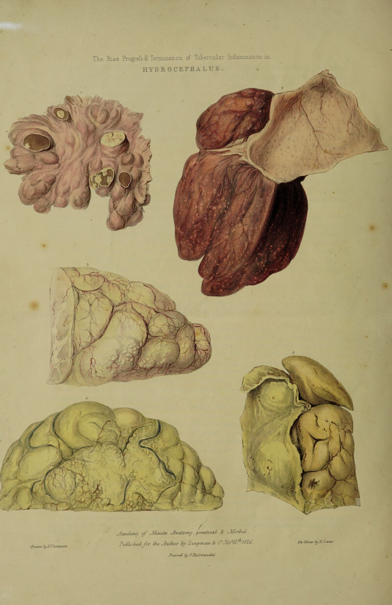 Tie Pise Progrefs & lermmation of Tubercular Mammaticm. m u^Sa 'Drawn/ byJIl hampsoiv- J^McUmy of Jlfemobe/ JhuxZovroy, yra/dwaZ & J/Torivd. Tvfflwkedfbr tkv Jtwbhor ~by 1 orucjTrum/ k C° iy ODuU'mand^O (hvSbotw by K/J* oune