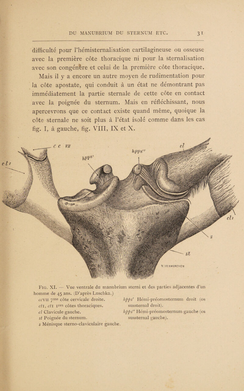 difficulté pour l’hémisternalisation cartilagineuse ou osseuse avec la première côte thoracique ni pour la sternalisation avec son congénère et celui de la première côte thoracique. Mais il y a encore un autre moyen de rudimentation pour la côte apostate, qui conduit à un état ne démontrant pas immédiatement la partie sternale de cette côte en contact avec la poignée du sternum. Mais en réfléchissant, nous apercevrons que ce contact existe quand même, quoique la côte sternale ne soit plus à l’état isolé comme dans les cas fig. I, à gauche, fig. VIII, IX et X. Fig. XI. — Vue ventrale du manubrium sterni et des parties adjacentes d’un homme de 45 ans. (D’après Luschka.) ccv 11 7me côte cervicale droite. et 1, eti ires côtes thoraciques. cl Clavicule gauche. st Poignée du sternum. 5 Ménisque sterno-claviculaire gauche. hpps' Hémi-préomosternum droit (os sussternal droit). hpps Hémi-préomosternum gauche (os sussternal gauche).