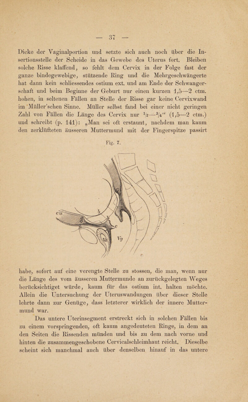 Dicke der Vaginalportion und setzte sick aucli nocb liber die In- sertionsstelle der Scbeide in das Gewebe des Uterus fort. Bleiben solche Risse klaffend, so fehlt dem Cervix in der Polge fast der ganze bindegewebige, sttitzende Ring und die Mehrgeschwangerte hat dann kein schliessendes ostium ext. und am Ende der Schwanger- schaft und beim Beginne der Geburt nur einen kurzen 1,5—2 ctm. hohen, in seltenen Fallen an Stelle der Risse gar keine Cervixwand im Mliller’schen Sinne. Muller selbst fand bei einer nicht geringen Zalil von Fallen die Lange des Cervix nur 1/2—(1,5—2 ctm.) und schreibt (p. 141): „Man sei oft erstaunt, nachdem man kaum den zerkltifteten ausseren Muttermund mit der Fingerspitze passirt Fig. 7. babe, sofort auf eine verengte Stelle zu stossen, die man, wenn nur die Lange des vom ausseren Muttermunde an zurtickgelegten Weges berlicksicbtiget wtirde, kaum fur das ostium int. halten rnoehte. Allein die Untersucbung der Uteruswandungen liber dieser Stelle lehrte dann zur Genlige, dass letzterer wirklicb der innere Mutter¬ mund war. Das untere Uterinsegment erstreckt sich in solcben Fallen bis zu einem vorspringenden, oft kaum angedeuteten Ringe, in dem an den Seiten die Rissenden mlinden und bis zu dem nach vorne und binten die zusammengescbobene Cervicalscbleimhaut reicbt. Dieselbe scbeint sieb mancbmal auch iiber denselben hinauf in das untere
