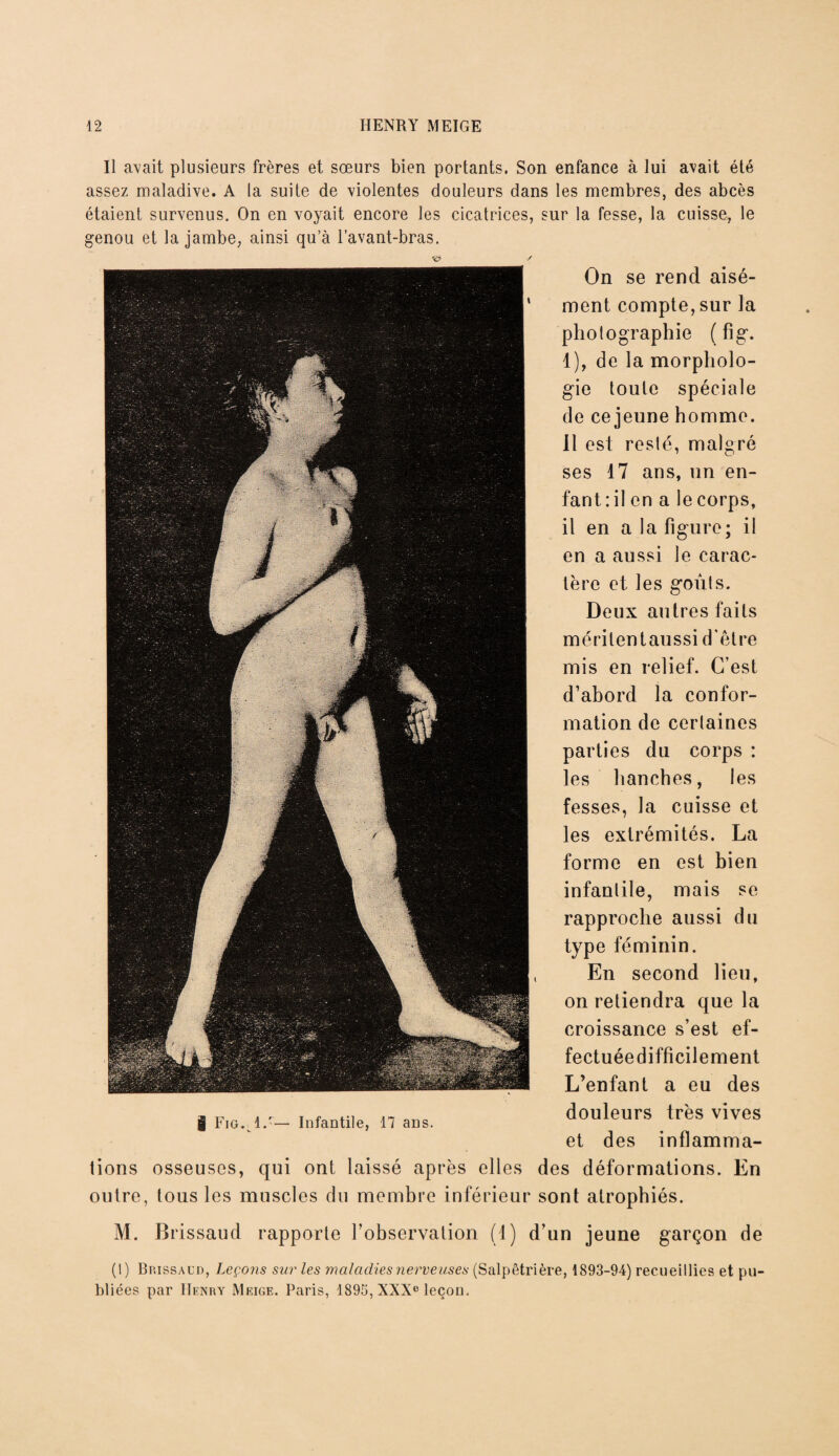 Il avait plusieurs frères et sœurs bien portants. Son enfance à lui avait été assez maladive. A la suite de violentes douleurs dans les membres, des abcès étaient survenus. On en voyait encore les cicatrices, sur la fesse, la cuisse, le genou et la jambe, ainsi qu’à l’avant-bras. •c? s On se rend aisé¬ ment compte, sur la photographie ( fi g. 1), de la morpholo¬ gie toute spéciale de ce jeune homme. Il est resté, malgré ses 17 ans, un en- fan t : il en a lecorps, il en a la figure; il en a aussi le carac¬ tère et les goûts. Deux autres faits méritent aussi d'être mis en relief. C’est d’abord la confor¬ mation de certaines parties du corps : les hanches, les fesses, la cuisse et les extrémités. La forme en est bien infantile, mais se rapproche aussi du type féminin. , En second lieu, on retiendra que la croissance s’est ef¬ fectuée difficilement L’enfant a eu des douleurs très vives et des inflamma¬ tions osseuses, qui ont laissé après elles des déformations. En outre, tous les muscles du membre inférieur sont atrophiés. M. Brissaud rapporte l’observation (1) d’un jeune garçon de (I) Bp.issaud, Leçons sur les maladies nerveuses (Salpêtrière, 1893-94) recueillies et pu¬ bliées par Henry Meige. Paris, 1895, XXXe leçon. | Fig. 1.'— Infantile, 17 ans.