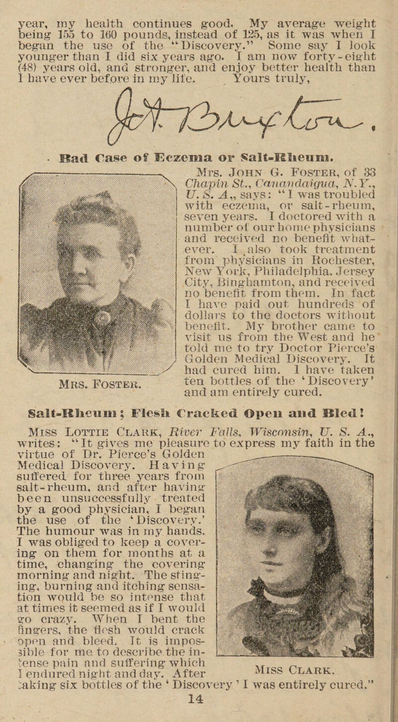 year, my health continues good- My average weight being 155 to 160 pounds, instead of 125, as it was when I began the use of the “Discovery.” Some say I look younger than I did six years ago. T am now forty-eight (48) years old, and stronger, and enjoy better health than I have ever before in my life. Yours truly, Bad. Case of Eczema or Salt-Mlieum. Mrs. John G. Foster, of 33 Chapin St., Canandaigua, N.Y., TJ. S. A„ says: “I was troubled with eczema, or salt-rheum, seven years. I doctored with a number of our home physicians and received no benefit what¬ ever. I .also took treatment from physicians in Rochester, New York, Philadelphia. Jersey .City, Binghamton, and received no benefit from them. In fact I have paid out hundreds of dollars to the doctors without benefit. My brother came to visit us from the West and he told me to try Doctor Pierce’s Golden Medical Discovery. It had cured him. 1 have taken ten bottles of the ‘Discovery’ and am entirely cured. Salt-Iilieii m; Flesh Cracked ©pen and Bled! Miss Lottie Clark, River Falls, Wisconsin, TJ. S. A., writes: “It gives me pleasure to express my faith in the virtue of Dr. Pierce’s Golden Medical Discovery. Having suffered for three years from salt-rheum, and after having been unsuccessfully treated by a good physician, I began the use of the ‘Discovery.’ The humour was in my hands. I was obliged to keep a cover¬ ing on them for months at a time, changing the covering morning and night. The sting¬ ing, burning and itching sensa¬ tion would be so intense that at times it seemed as if I would go crazy. When T bent the lingers, the flesh would crack open and bleed. It is impos¬ sible for me to describe.the in¬ tense pain and suffering which 1 endured night and day. After :aking six bottles of the ‘ Discovery 11 was entirely cured.” Miss Clark.