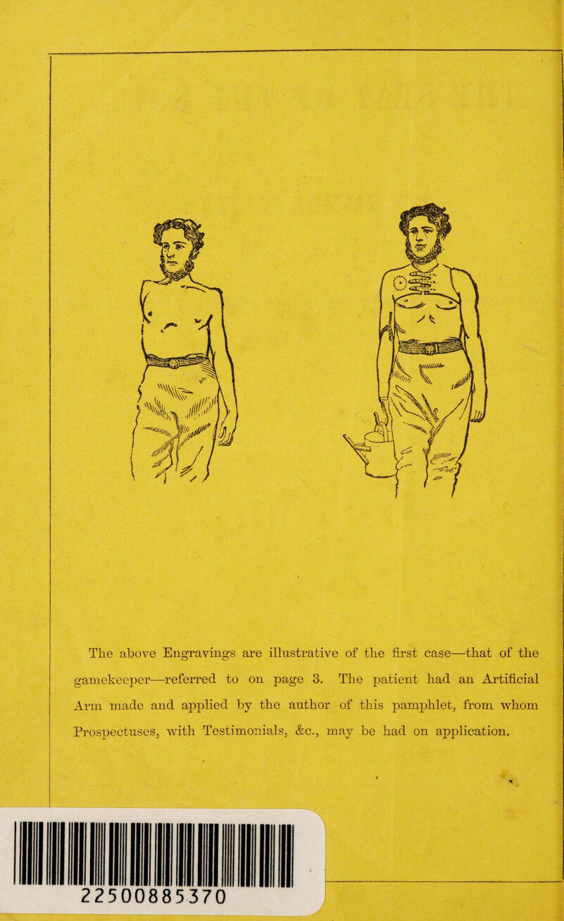 The above Engravings are illustrative of the first case—that of the gamekeeper—referred to on page 3. The patient had an Artificial Arm made and applied by the author of this pamphlet, from whom Prospectuses, with Testimonials, &c., may be had on application.