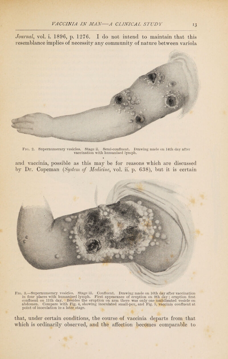 Journal, vol. i. 1896, p, 1276. I do not intend to maintain that this resemblance implies of necessity any community of nature between variola Fig. 2. Supernumerary vesicles. Stage ii. Semi-confluent. Drawing made on 14th day after vaccination with humanised lymph. and vaccinia, possible as this may be for reasons which are discussed by Dr. Copeman (System of Medicine, vol. ii. p. 638), but it is certain Fig. 3.—Supernumerary vesicles. Stage iii. Confluent. Drawing made on 16th day after vaccination in four places with humanised lymph. First appearance of eruption on 9th day; eruption first confluent on 11th day. Besides the eruption on arm there was only one umbilicated vesicle on abdomen. Compare with Fig. 4, showing inoculated small-pox, and Fig. 5, vaccinia confluent at point of inoculation in a later stage. that, under certain conditions, the course of vaccinia departs from that which is ordinarily observed, and the affection becomes comparable to