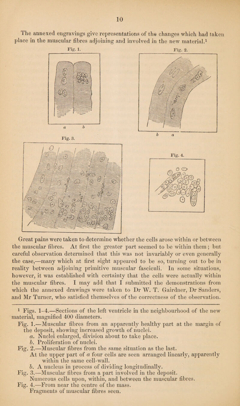 The annexed engravings give representations of the changes which had taken place in the muscular fibres adjoining and involved in the new material.1 Great pains were taken to determine whether the cells arose within or between the muscular fibres. At first the greater part seemed to be within them; but careful observation determined that this was not invariably or even generally the case,—many which at first sight appeared to be so, turning out to be in reality between adjoining primitive muscular fasciculi. In some situations, however, it was established with certainty that the cells were actually within the muscular fibres. I may add that I submitted the demonstrations from which the annexed drawings were taken to Dr W. T. Gairdner, Dr Sanders, and Mr Turner, who satisfied themselves of the correctness of the observation. 1 Figs. 1-4.—Sections of the left ventricle in the neighbourhood of the new material, magnified 400 diameters. Fig. 1.—Muscular fibres from an apparently healthy part at the margin of the deposit, showing increased growth of nuclei. a. Nuclei enlarged, division about to take place. b. Proliferation of nuclei. Fig. 2.—Muscular fibres from the same situation as the last. At the upper part of a four cells are seen arranged linearly, apparently within the same cell-wall. b. A nucleus in process of dividing longitudinally. Fig. 3.—Muscular fibres from a part involved in the deposit. Numerous cells upon, within, and between the muscular fibres. Fig. 4.—From near the centre of the mass. Fragments of muscular fibres seen.