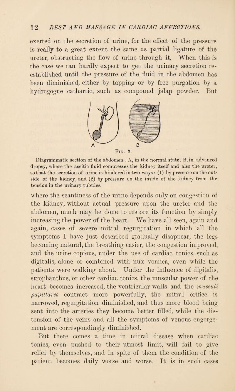 exerted on the secretion of urine, for the effect of the pressure is really to a great extent the same as partial ligature of the ureter, obstructing the flow of urine through it. When this is the case we can hardly expect to get the urinary secretion re¬ established until the pressure of the fluid in the abdomen has been diminished, either by tapping or by free purgation by a hydrogogue cathartic, such as compound jalap powder. But Diagrammatic section of the abdomen : A, in the normal state; B, in advanced dropsy, where the ascitic fluid compresses the kidney itself and also the ureter, so that the secretion of urine is hindered in two ways : (1) by pressure on the out¬ side of the kidney, and (2) by pressure on the inside of the kidney from the tension in the urinary tubules. where the scantiness of the urine depends only on congestion of the kidney, without actual pressure upon the ureter and the abdomen, much may be done to restore its function by simply increasing the power of the heart. We have all seen, again and again, cases of severe mitral regurgitation in which all the symptoms I have just described gradually disappear, the legs becoming natural, the breathing easier, the congestion improved, and the urine copious, under the use of cardiac tonics, such as digitalis, alone or combined with nux vomica, even while the patients were walking about. Under the influence of digitalis, strophanthus, or other cardiac tonics, the muscular power of the heart becomes increased, the ventricular walls and the musculi pcqnllares contract more powerfully, the mitral orifice is narrowed, regurgitation diminished, and thus more blood being sent into the arteries they become better filled, while the dis¬ tension of the veins and all the symptoms of venous engorge¬ ment are correspondingly diminished. But there comes a time in mitral disease when cardiac tonics, even pushed to their utmost limit, will fail to give relief by themselves, and in spite of them the condition of the patient becomes daily worse and worse. It is in such cases