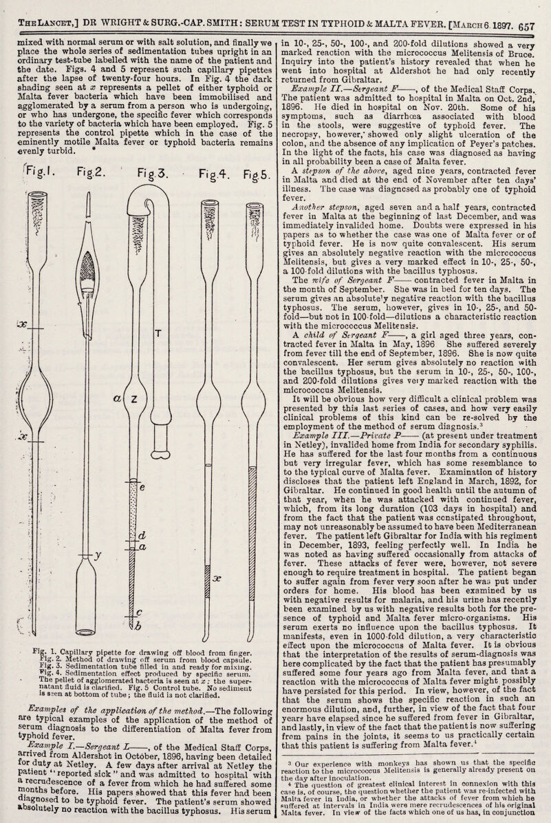 mixed with normal serum or with salt solution, and finally we place the whole series of sedimentation tubes upright in an ordinary test-tube labelled with the name of the patient and the date. Figs. 4 and 5 represent such capillary pipettes after the lapse of twenty-four hours. In Fig. 4 the dark shading seen at x represents a pellet of either typhoid or Malta fever bacteria which have been immobilised and agglomerated by a serum from a person who is undergoing, or who has undergone, the specific fever which corresponds to the variety of bacteria which have been employed. Fig. 5 represents the control pipette which in the case of the eminently motile Malta fever or typhoid bacteria remains evenly turbid. * Fig.2. Fig 3. Fig.4. Fig.5. Figr. 1. Capillary pipette for drawing off blood from finger. Mg. 2. Method of drawing off serum from blood capsule. 1 ig. 3. Sedimentation tube filled in and ready for mixing. Mg. 4. Sedimentation effect produced by specific serum. The pellet of agglomerated bacteria is seen at x : the super¬ natant fluid is clarified. Fig. 5 Control tube. No sediment is seen at bottom of tube; the fluid is not clarified. Examples of the application of the method.—The following are typical examples of the application of the method of serum diagnosis to the differentiation of Malta fever from typhoid fever. Example I.—Sergeant L-, of the Medical Staff Corps, arrived from Aldershot in October, 1896, having been detailed lor duty at Netley. A few days after arrival at Netley the patient “reported sick ” and was admitted to hospital with a recrudescence of a fever from which he had suffered some Months before. His papers showed that this fever had been lagnosed to be typhoid fever. The patient’s serum showed a* solutely no reaction with the bacillus typhosus. His serum in 10-, 25*, 50”, 100*, and 200*fold dilutions showed a very marked reaction with the micrococcus Melitensis of Bruce. Inquiry into the patient’s history revealed that when he went into hospital at Aldershot he had only recently returned from Gibraltar. Example II.—Sergeant F-, of the Medical Staff Corps. The patient was admitted to hospital in Malta on Oct. 2nd, 1896. He died in hospital on Nov. 20th. Some of his symptoms, such as diarrhoea associated with blood in the stools, were suggestive of typhoid fever. The necropsy, however,* showed only slight ulceration of the colon, and the absence of any implication of Peyer’s patches. In the light of the facts, his case was diagnosed as having in all probability been a case of Malta fever. A stepson of the above, aged nine years, contracted fever in Malta and died at the end of November after ten days’ illness. The case was diagnosed as probably one of typhoid fever. Another stepson, aged seven and a half years, contracted fever in Malta at the beginning of last December, and was immediately invalided home. Doubts were expressed in his papers as to whether the case was one of Malta fever or of typhoid fever. He is now quite convalescent. His serum gives an absolutely negative reaction with the micrococcus Melitensis, but gives a very marked effect in 10-, 25*, 50-, a 100-fold dilutions with the bacillus typhosus. The wife of Sergeant F-contracted fever in Malta in the month of September. She was in bed for ten days. The serum gives an absolute’y negative reaction with the bacillus typhosus. The serum, however, gives in 10-, 25-, and 50- fold—but not in 100-fold—dilutions a characteristic reaction with the micrococcus Melitensis. A child of Strqeant F-, a girl aged three years, con¬ tracted fever in Malta in May, 1896 She suffered severely from fever till the end of September, 1896. She is now quite convalescent. Her serum gives absolutely no reaction with the bacillus typhosus, but the serum in 10-, 25-, 50-, 100-, and 200-fold dilutions gives very marked reaction with the micrococcus Melitensis. It will be obvious how very difficult a clinical problem was presented by this last series of cases, and how very easily clinical problems of this kind can be re-solved by the employment of the method of serum diagnosis.3 4 Example III.—Private P-(at present under treatment in Netley), invalided home from India for secondary syphilis. He has suffered for the last four months from a continuous but very irregular fever, which has some resemblance to to the typical curve of Malta fever. Examination of history discloses that the patient left England in March, 1892, for Gibraltar. He continued in good health until the autumn of that year, when he was attacked with continued fever, which, from its long duration (103 days in hospital) and from the fact that the patient was constipated throughout, may not unreasonably be assumed to have been Mediterranean fever. The patient left Gibraltar for India with his regiment in December, 1893, feeling perfectly well. In India he was noted as having suffered occasionally from attacks of fever. These attacks of fever were, however, not severe enough to require treatment in hospital. The patieDt began to suffer again from fever very soon after he was put under orders for home. His blood has been examined by us with negative results for malaria, and his urine has recently been examined by us with negative results both for the pre¬ sence of typhoid and Malta fever micro-organisms. His serum exerts no influence upon the bacillus typhosus. It manifests, even in 1000-fold dilution, a very characteristic effect upon the micrococcus of Malta fever. It is obvious that the interpretation of the results of serum-diagnosis was here complicated by the fact that the patient has presumably suffered some four years ago from Malta fever, and that a reaction with the micrococcus of Malta fever might possibly have persisted for this period. In view, however, of the fact that the serum shows the specific reaction in such an enormous dilution, and, further, in view of the fact that four years have elapsed since he suffered from fever in Gibraltar, and lastly, in view of the fact that the patient is now suffering from pains in the joints, it seems to us practically certain that this patient is suffering from Malta fever.1 3 Our experience with monkeys has shown us that the specific reaction to the micrococcus Melitensis is generally already present on the day after inoculation. 4 The question of greatest clinical interest m connexion with this case is, of course, the question whether the patient was re-infected with Malta fever in India, or whether the attacks of fever from which he suffered at intervals in India were mere recrudescences of his original Malta fever. In view of the facts which one of us has, in conjunction